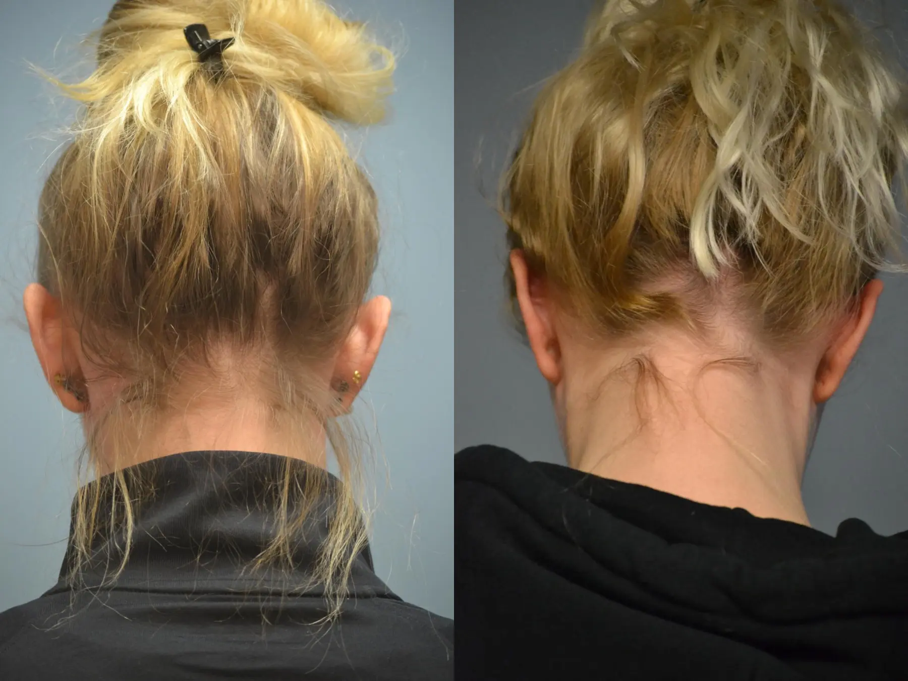 Otoplasty: Patient 3 - Before and After 5
