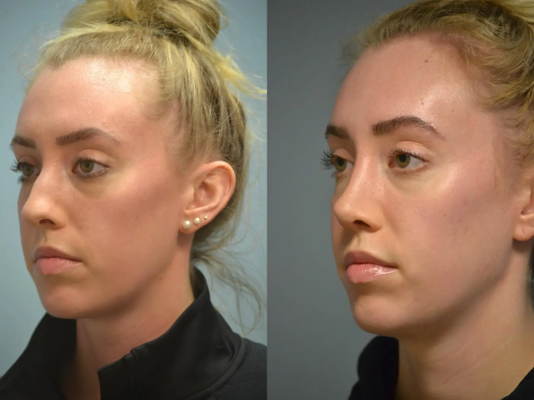 Otoplasty: Patient 4 - Before and After 2