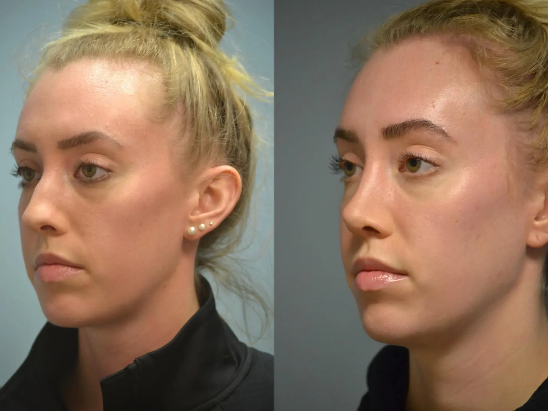 Otoplasty: Patient 3 - Before and After 2