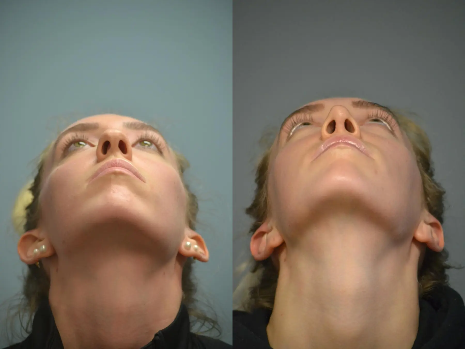 Otoplasty: Patient 4 - Before and After 4