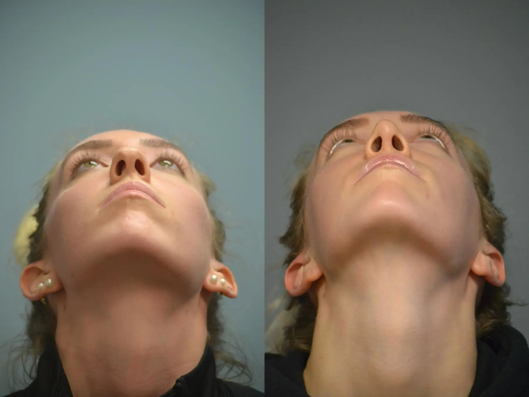 Otoplasty: Patient 3 - Before and After 4