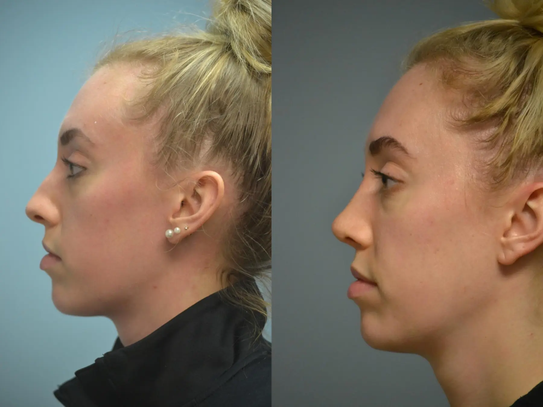 Otoplasty: Patient 3 - Before and After 3