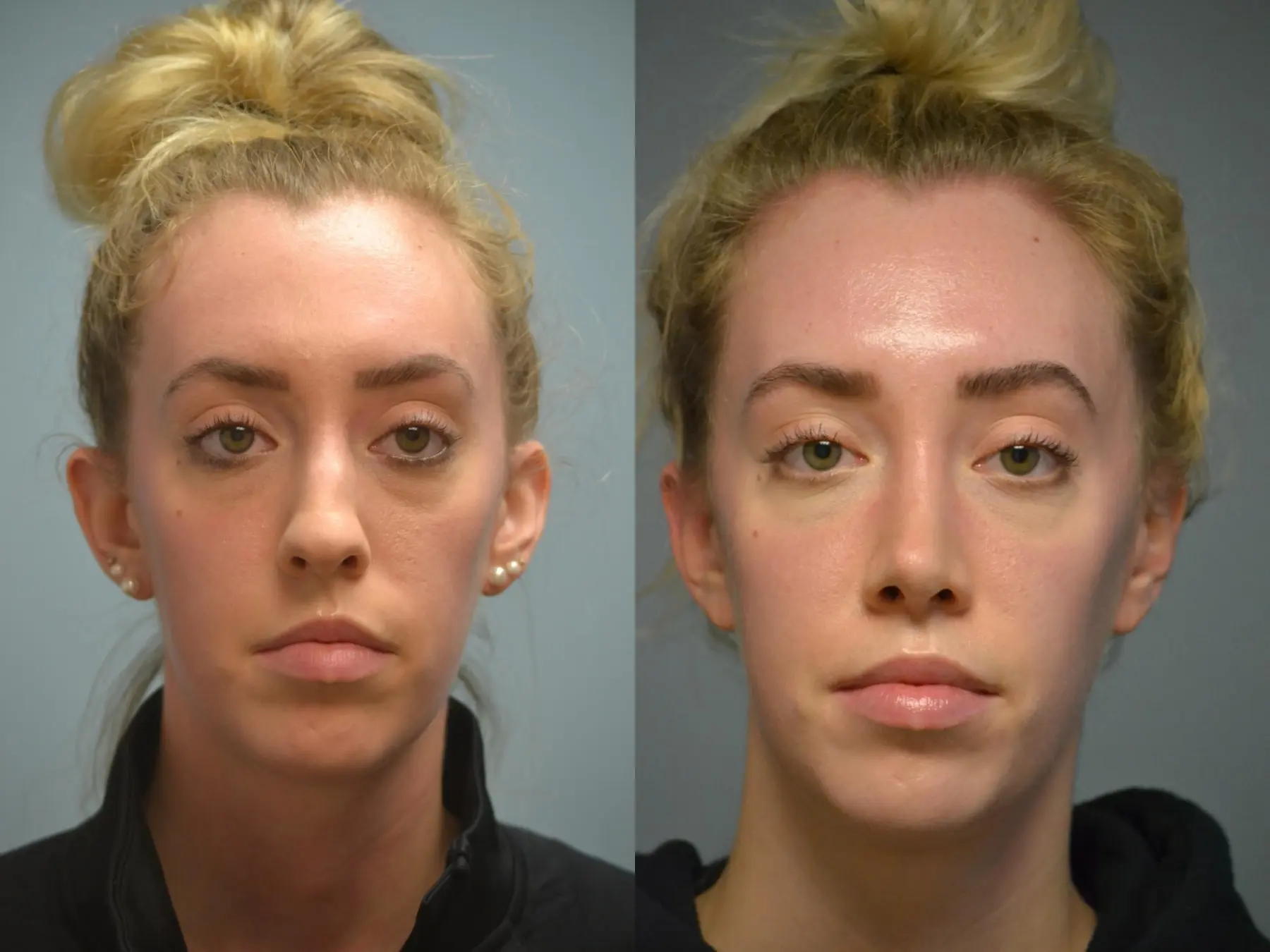 Otoplasty: Patient 4 - Before and After 1