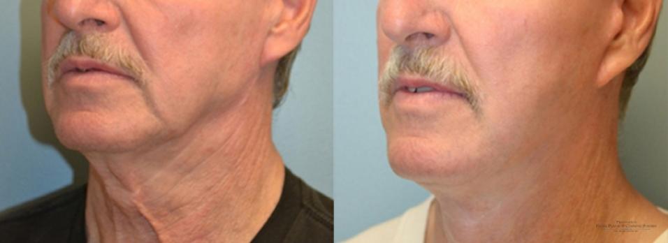 Facelift: Patient 5 - Before and After  