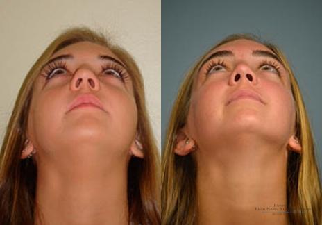 Rhinoplasty: Patient 33 - Before and After 6
