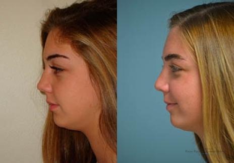 Rhinoplasty: Patient 33 - Before and After 2