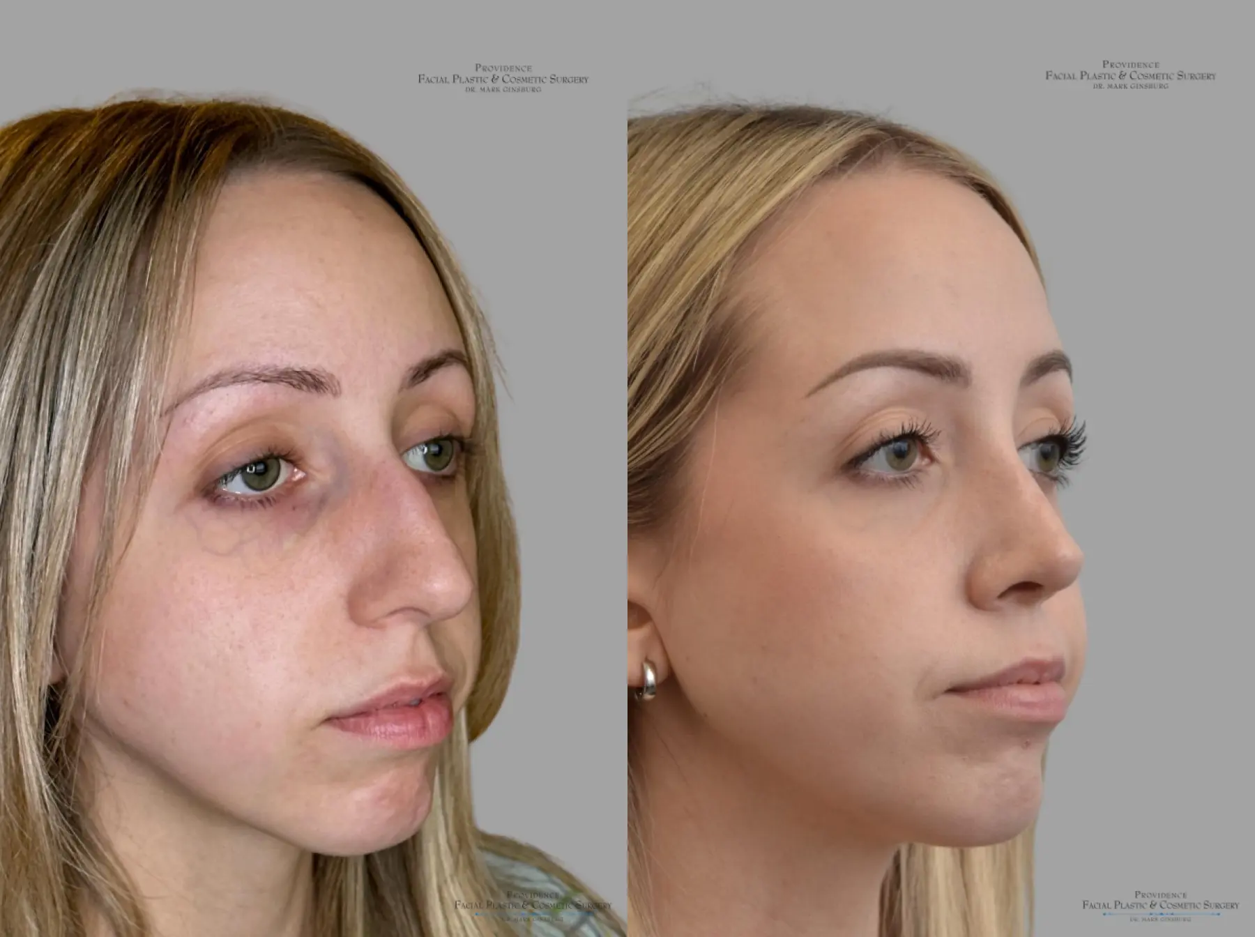 Rhinoplasty: Patient 42 - Before and After 2