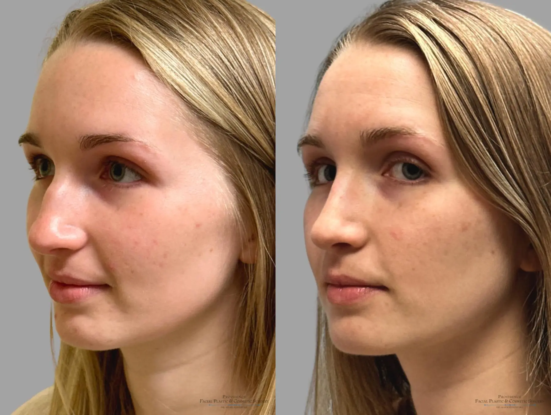 Rhinoplasty: Patient 39 - Before and After 5