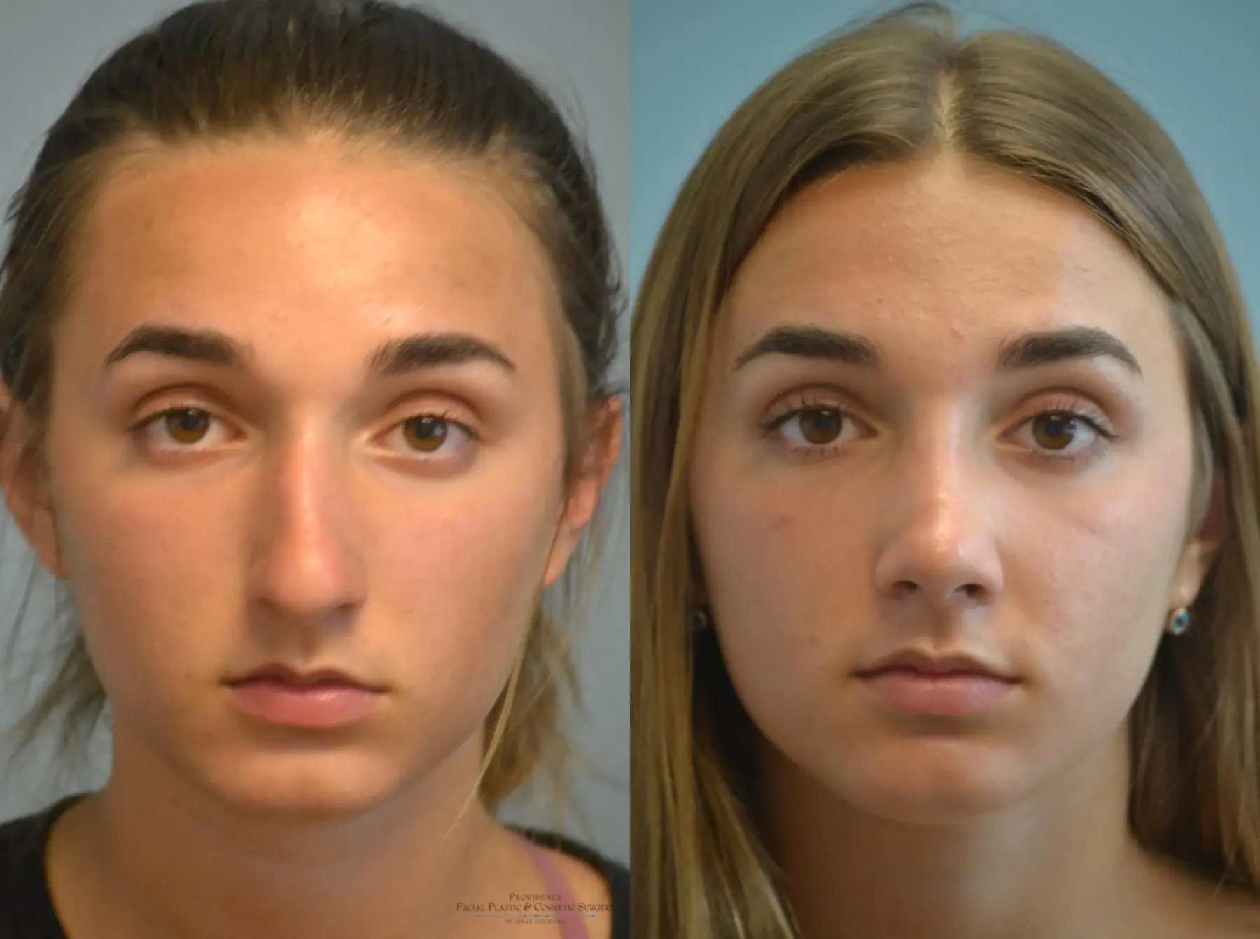 Rhinoplasty: Patient 8 - Before and After  