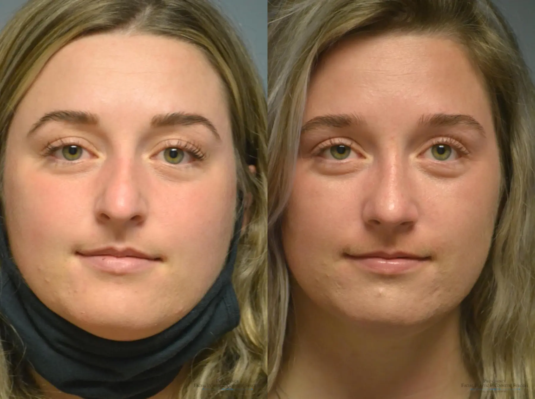 Rhinoplasty: Patient 9 - Before and After  