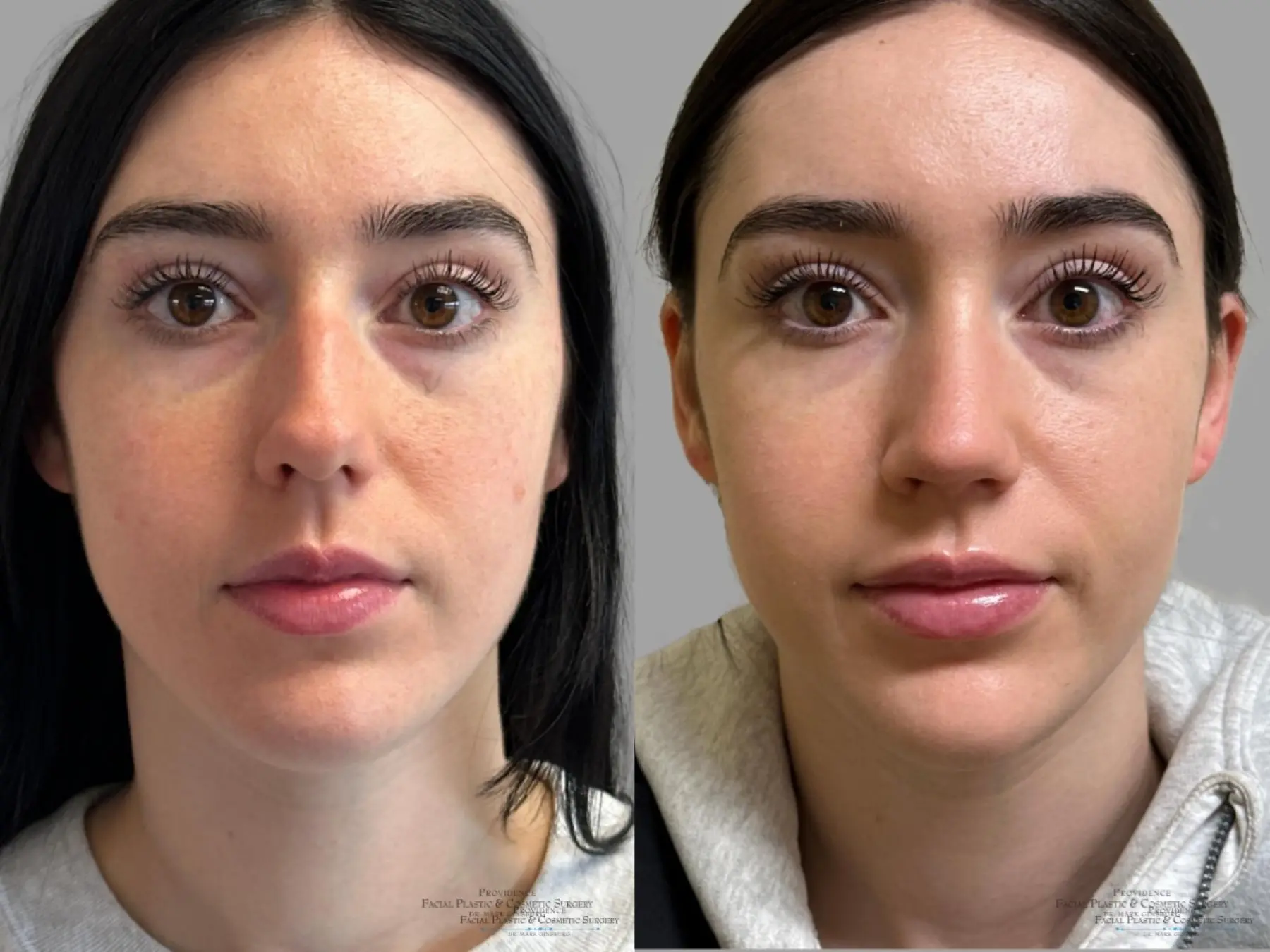 Rhinoplasty: Patient 37 - Before and After 1