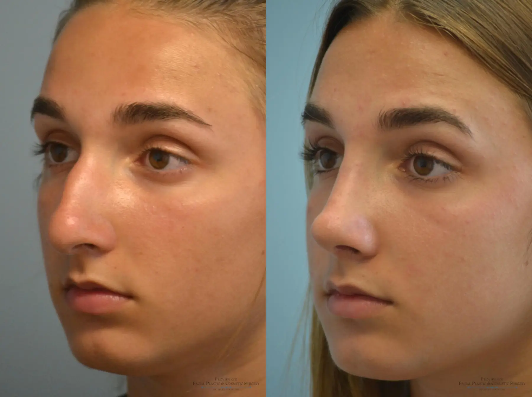 Rhinoplasty: Patient 8 - Before and After 2