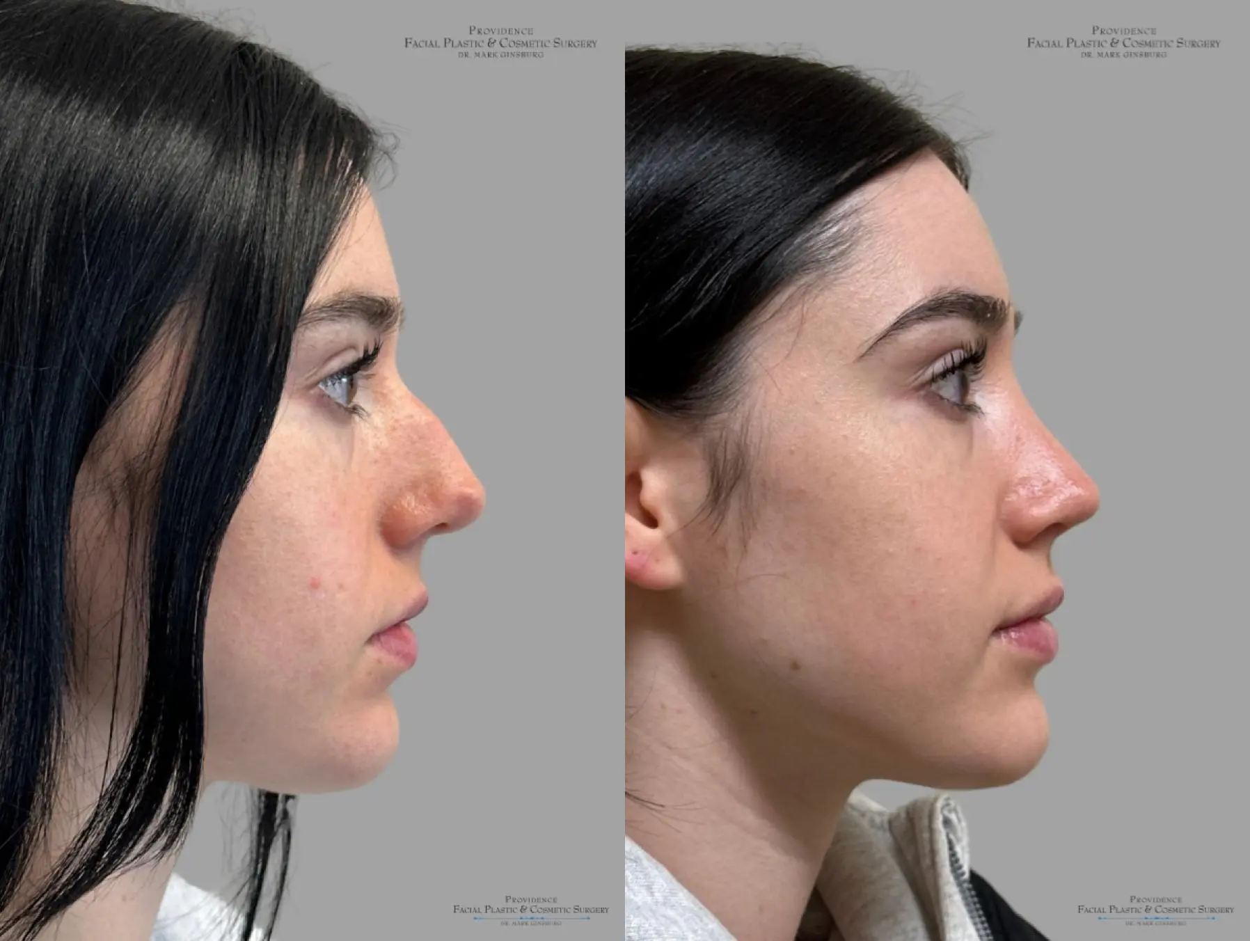 Rhinoplasty: Patient 37 - Before and After 4