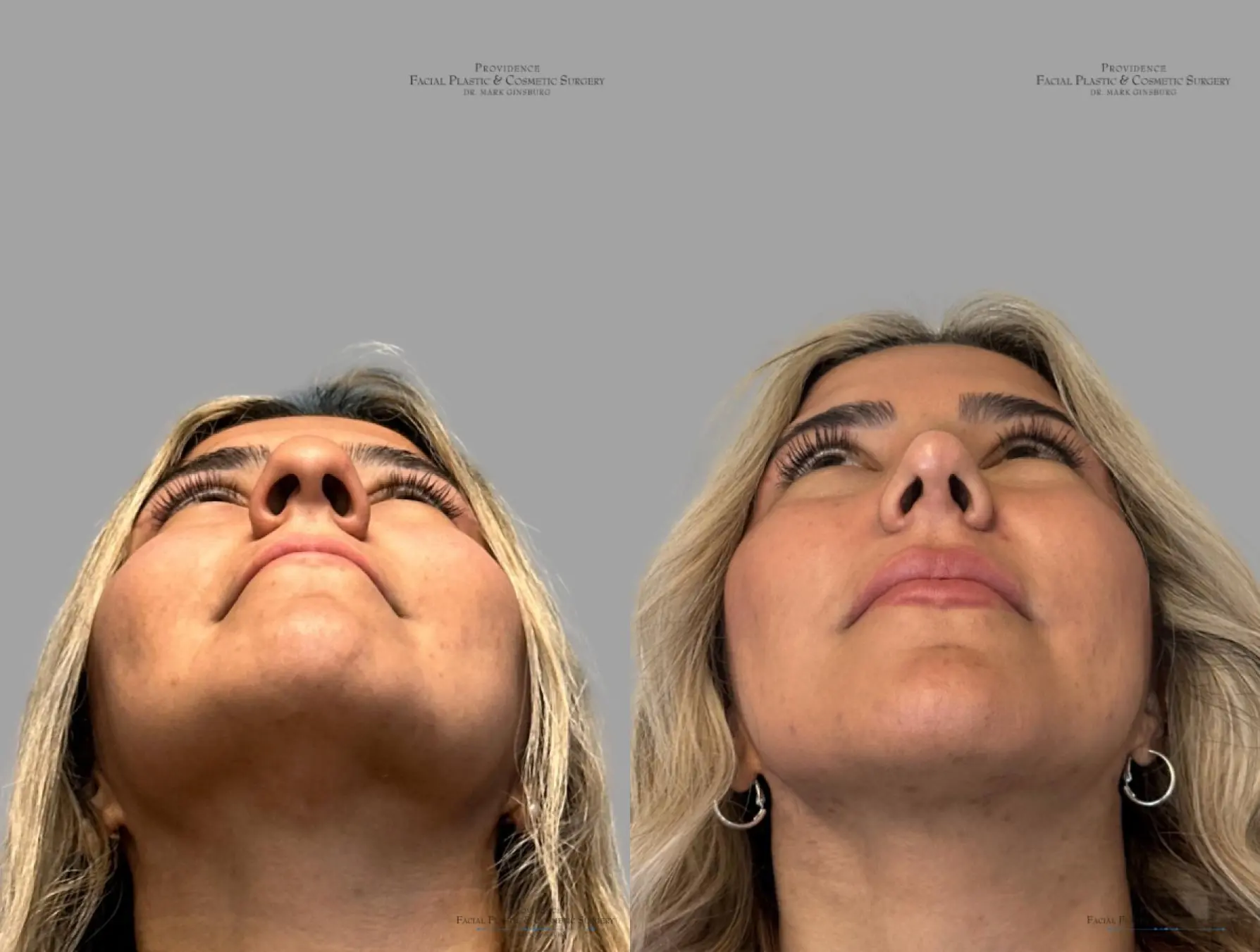 Rhinoplasty: Patient 35 - Before and After 2
