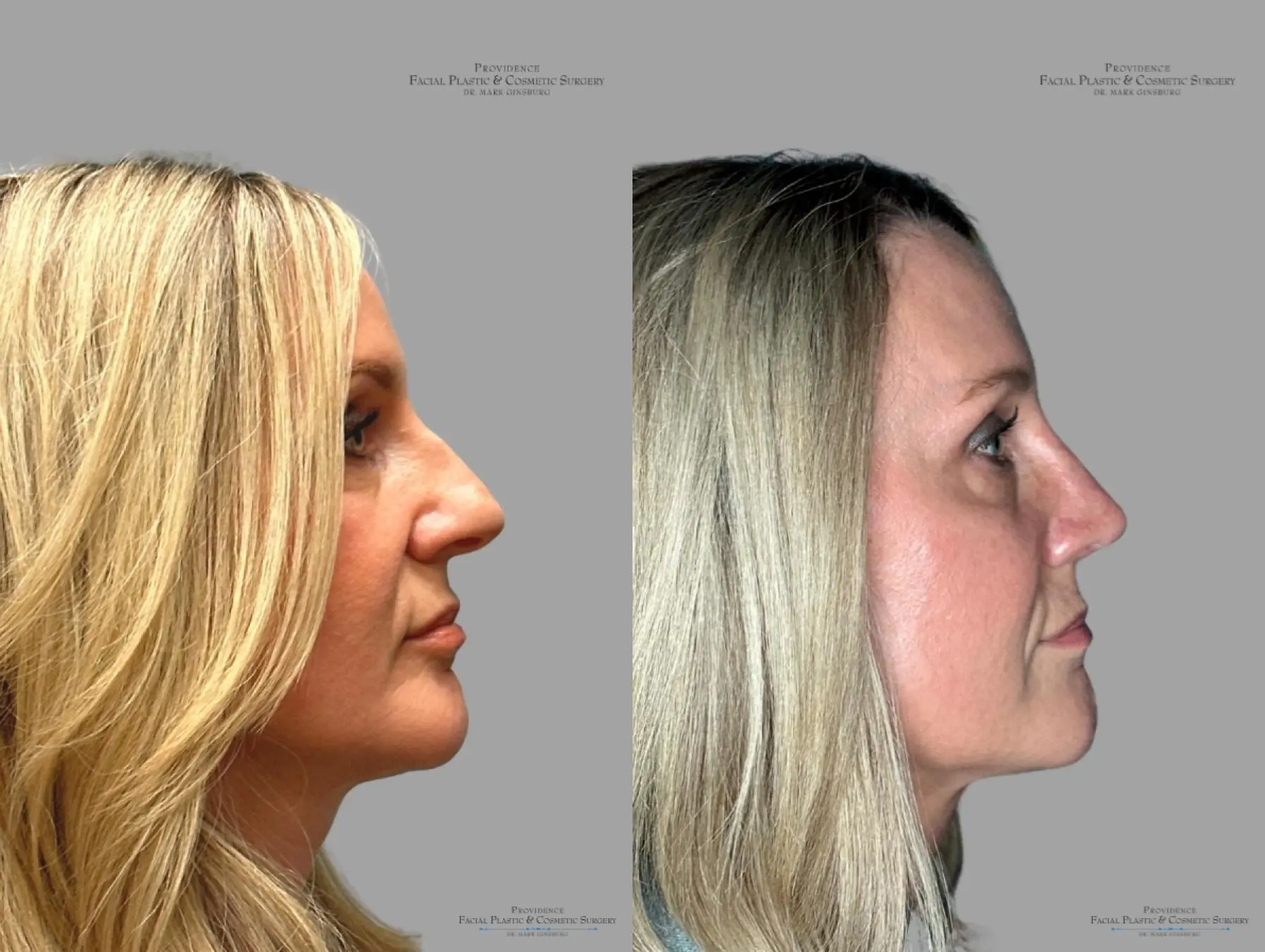 Rhinoplasty: Patient 38 - Before and After 4