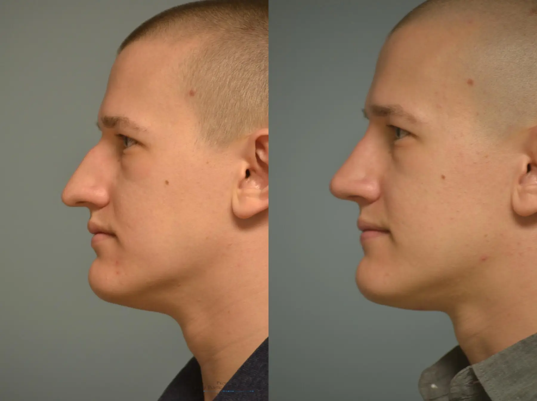 Rhinoplasty: Patient 20 - Before and After 4