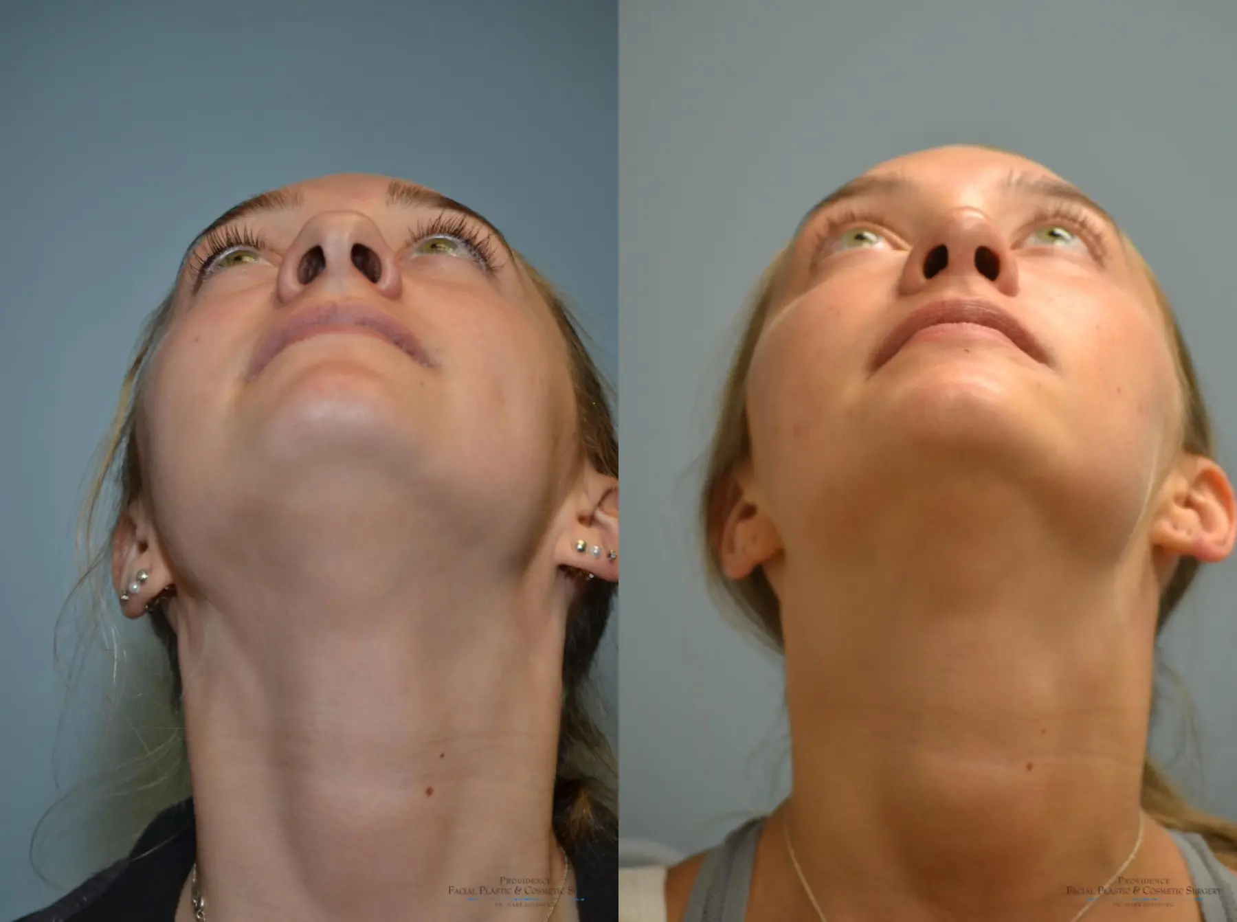 Rhinoplasty: Patient 19 - Before and After 5