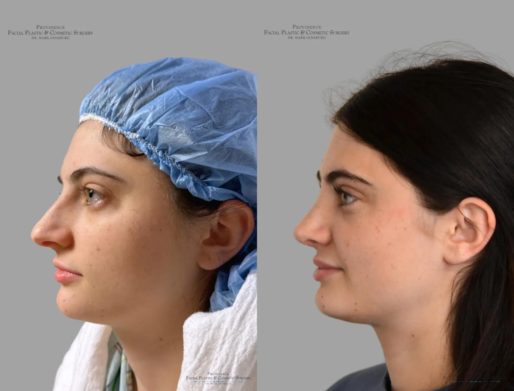 Rhinoplasty: Patient 43 - Before and After 5