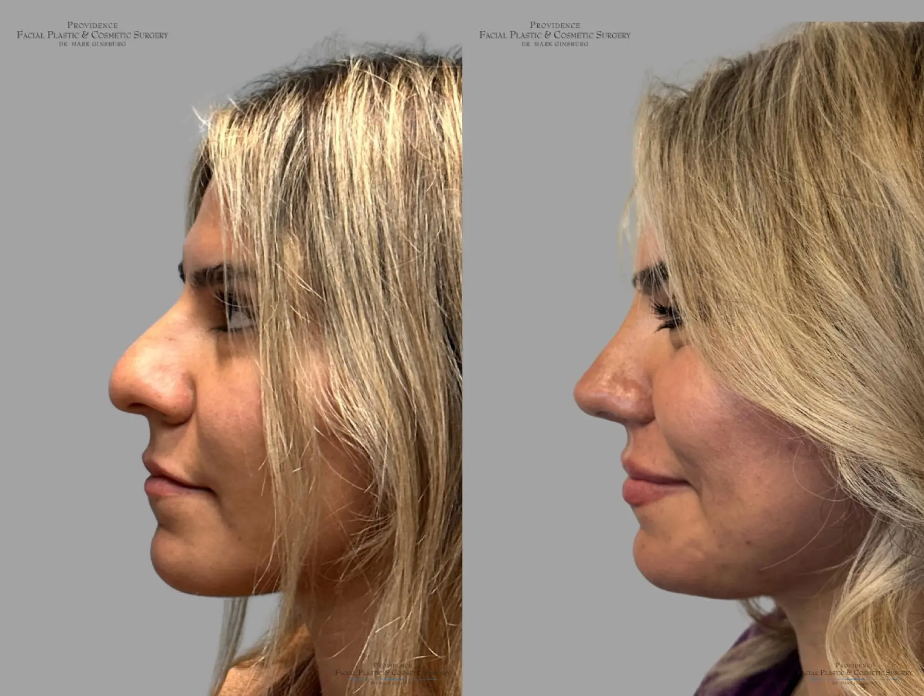 Rhinoplasty: Patient 35 - Before and After 6