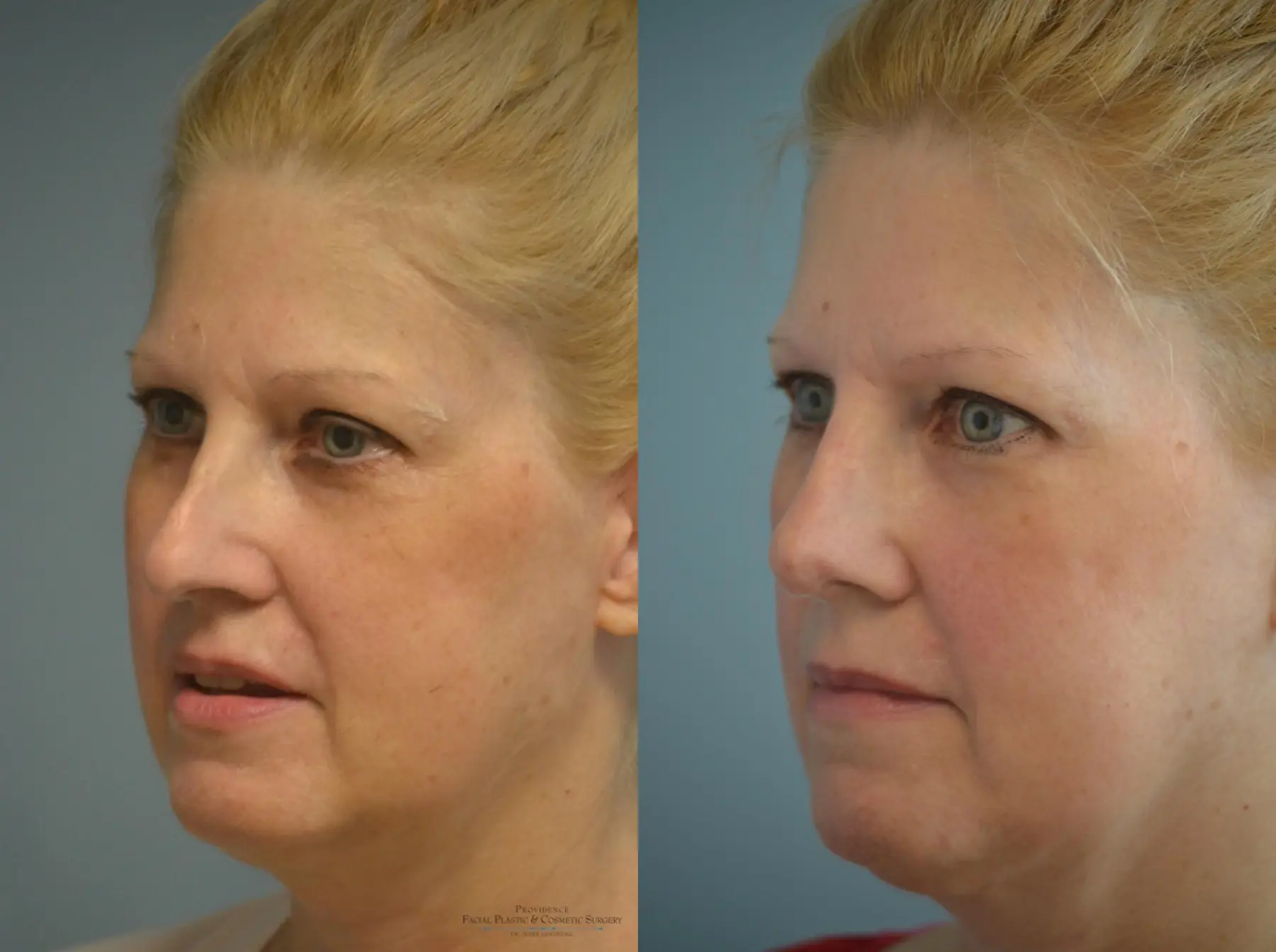 Rhinoplasty: Patient 7 - Before and After 2