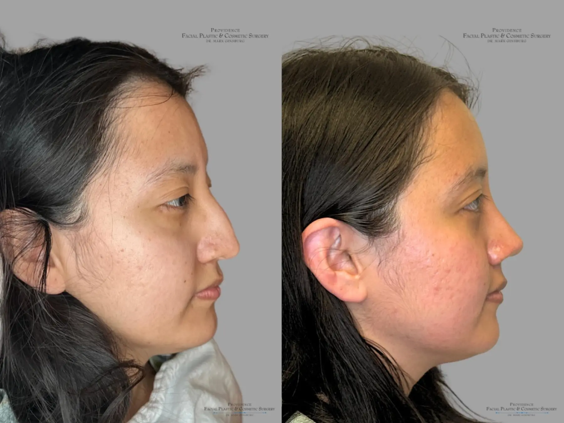 Rhinoplasty: Patient 31 - Before and After 3