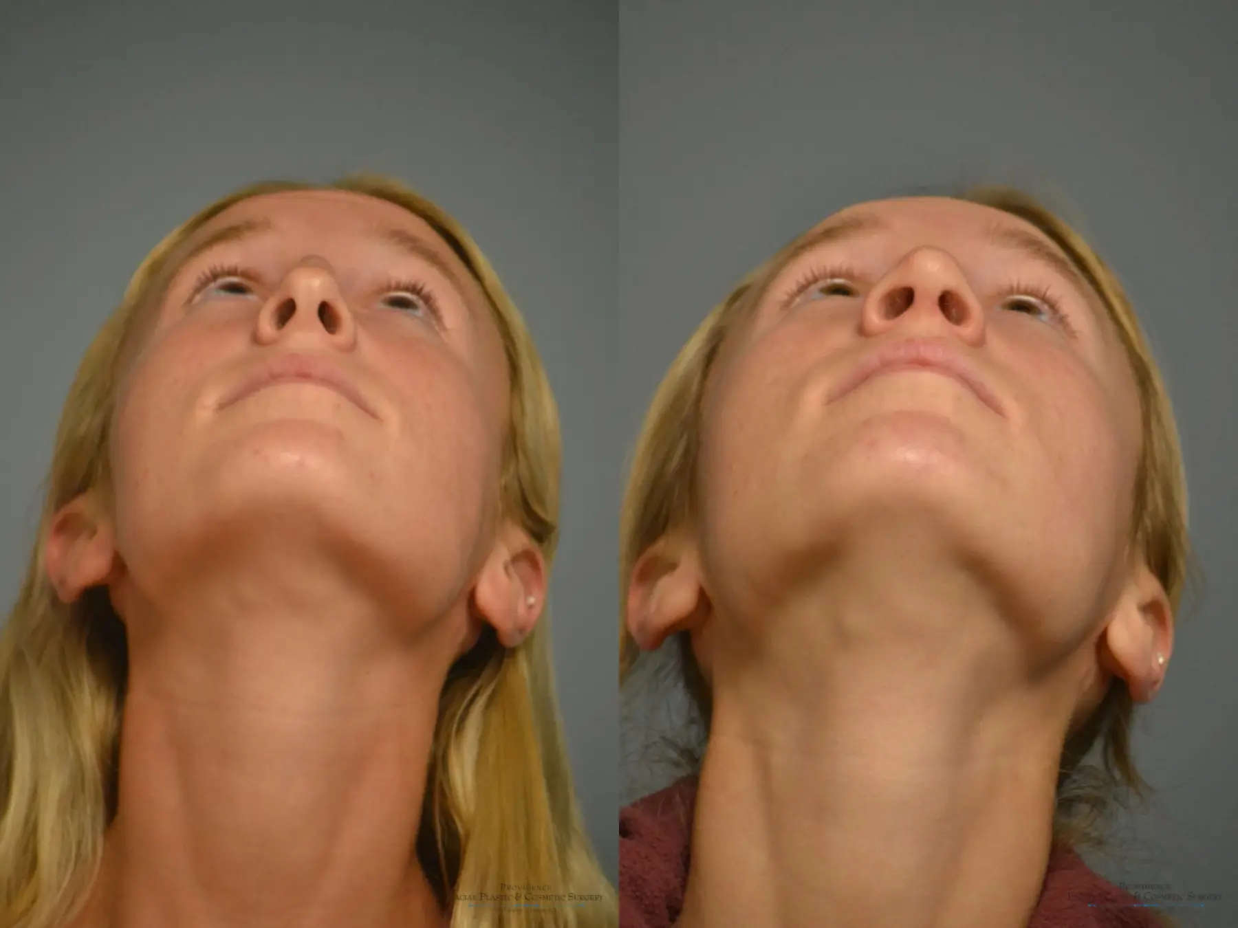 Rhinoplasty: Patient 22 - Before and After 5