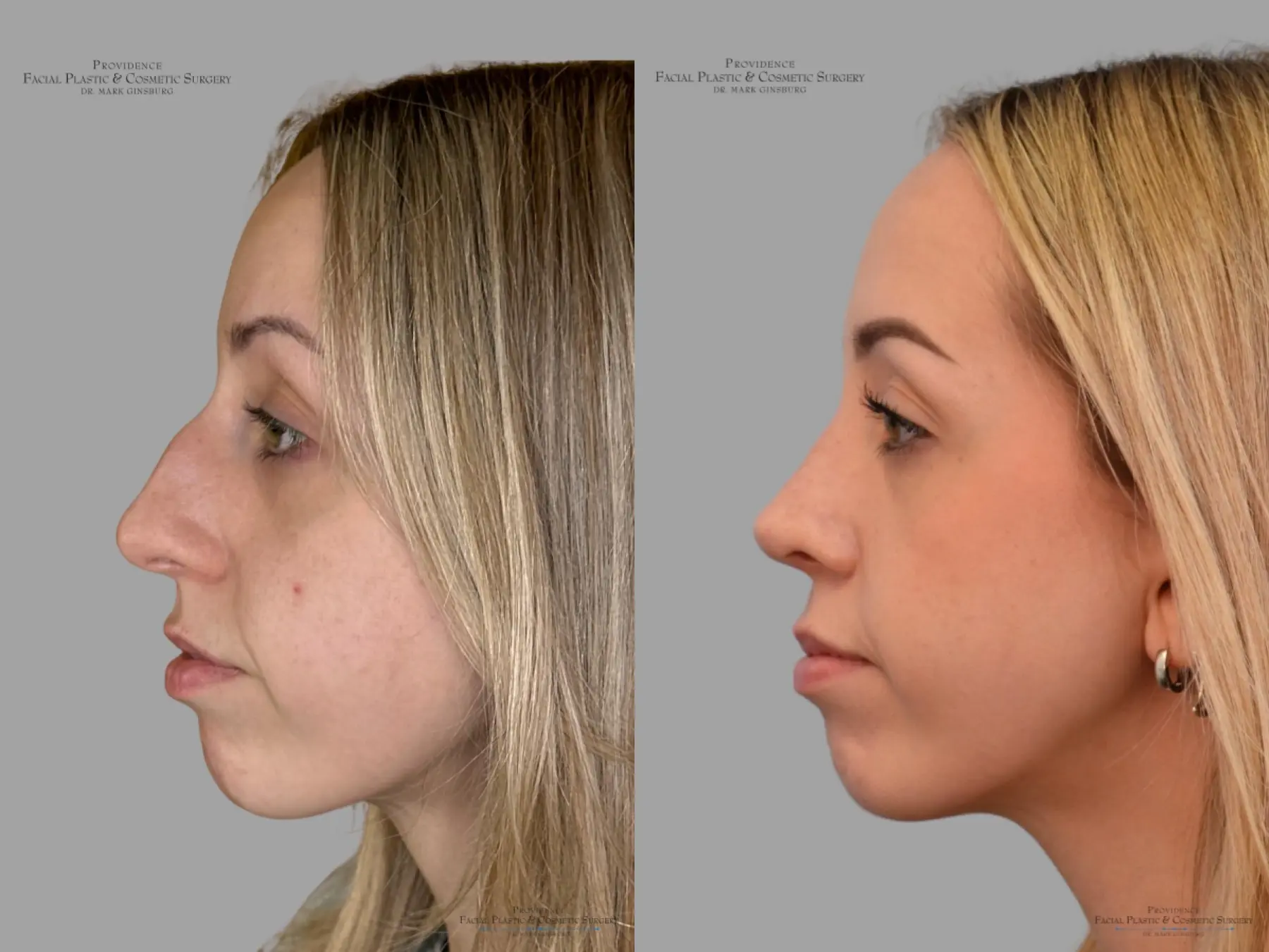 Rhinoplasty: Patient 42 - Before and After 5