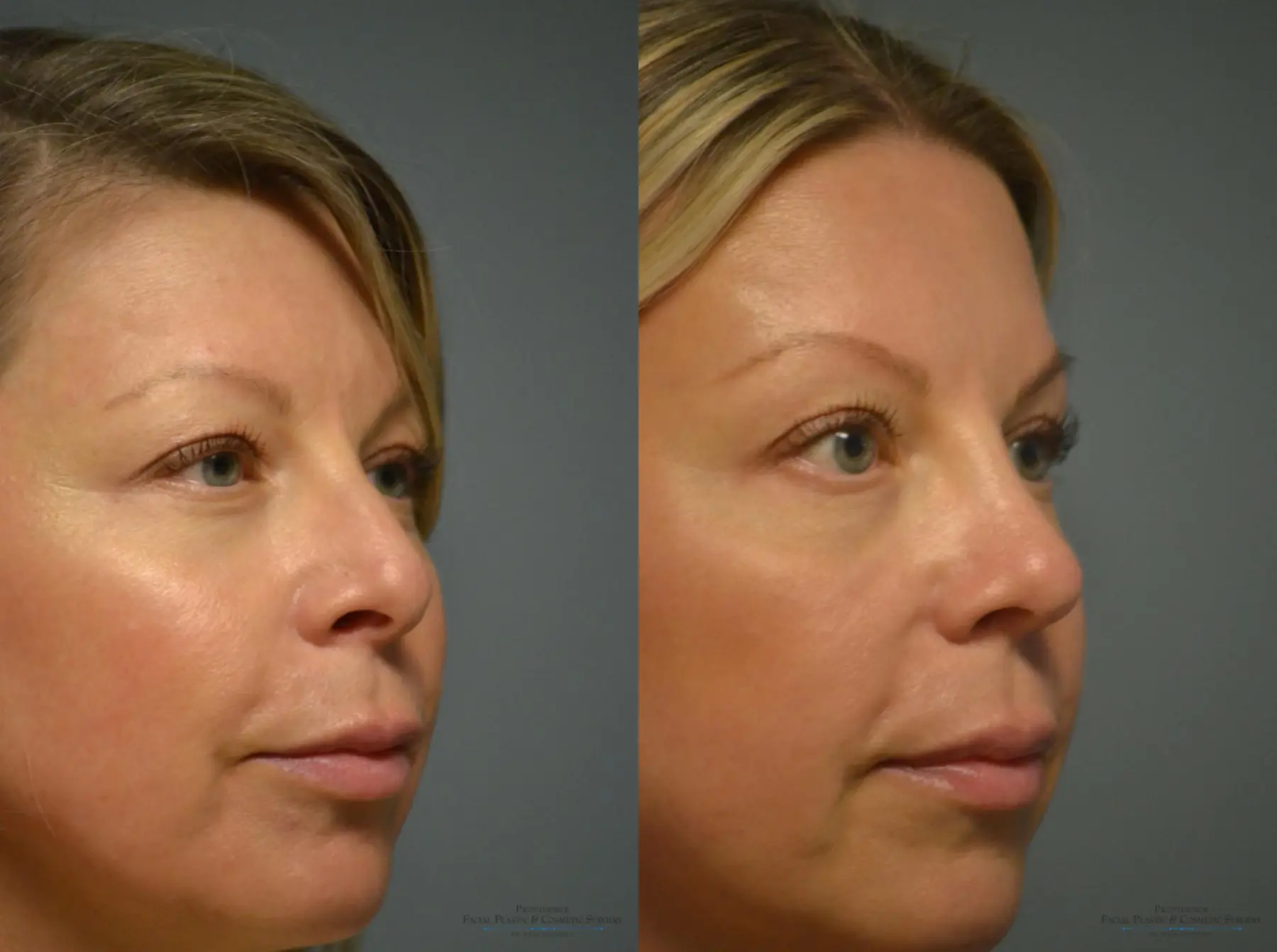 Rhinoplasty: Patient 4 - Before and After 3