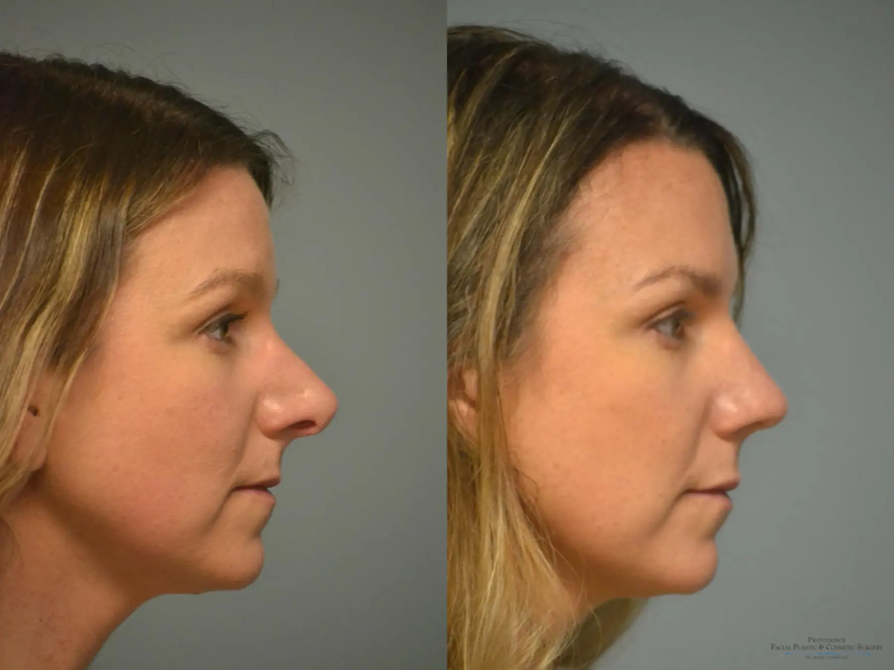 Rhinoplasty: Patient 13 - Before and After 4