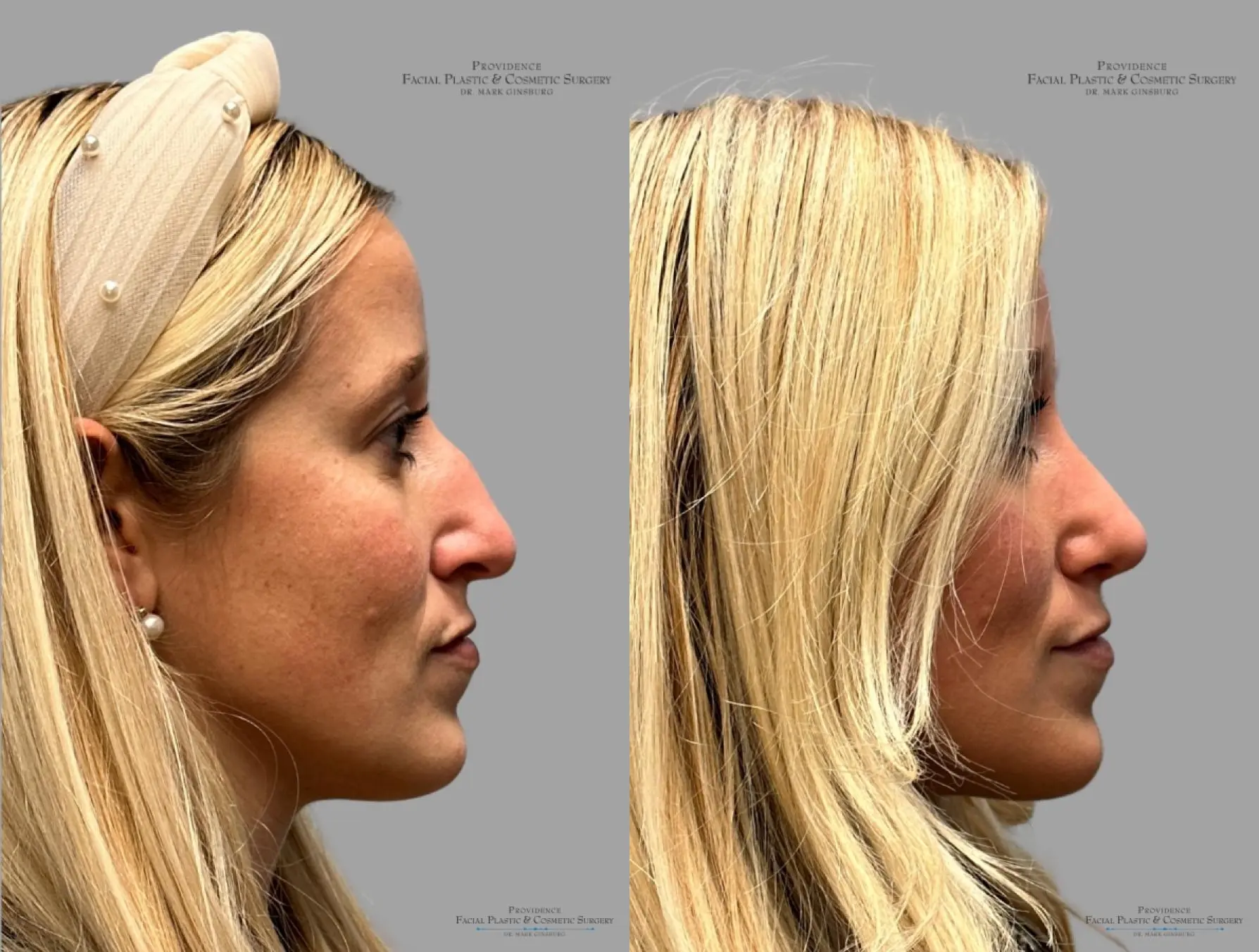Rhinoplasty: Patient 34 - Before and After 4