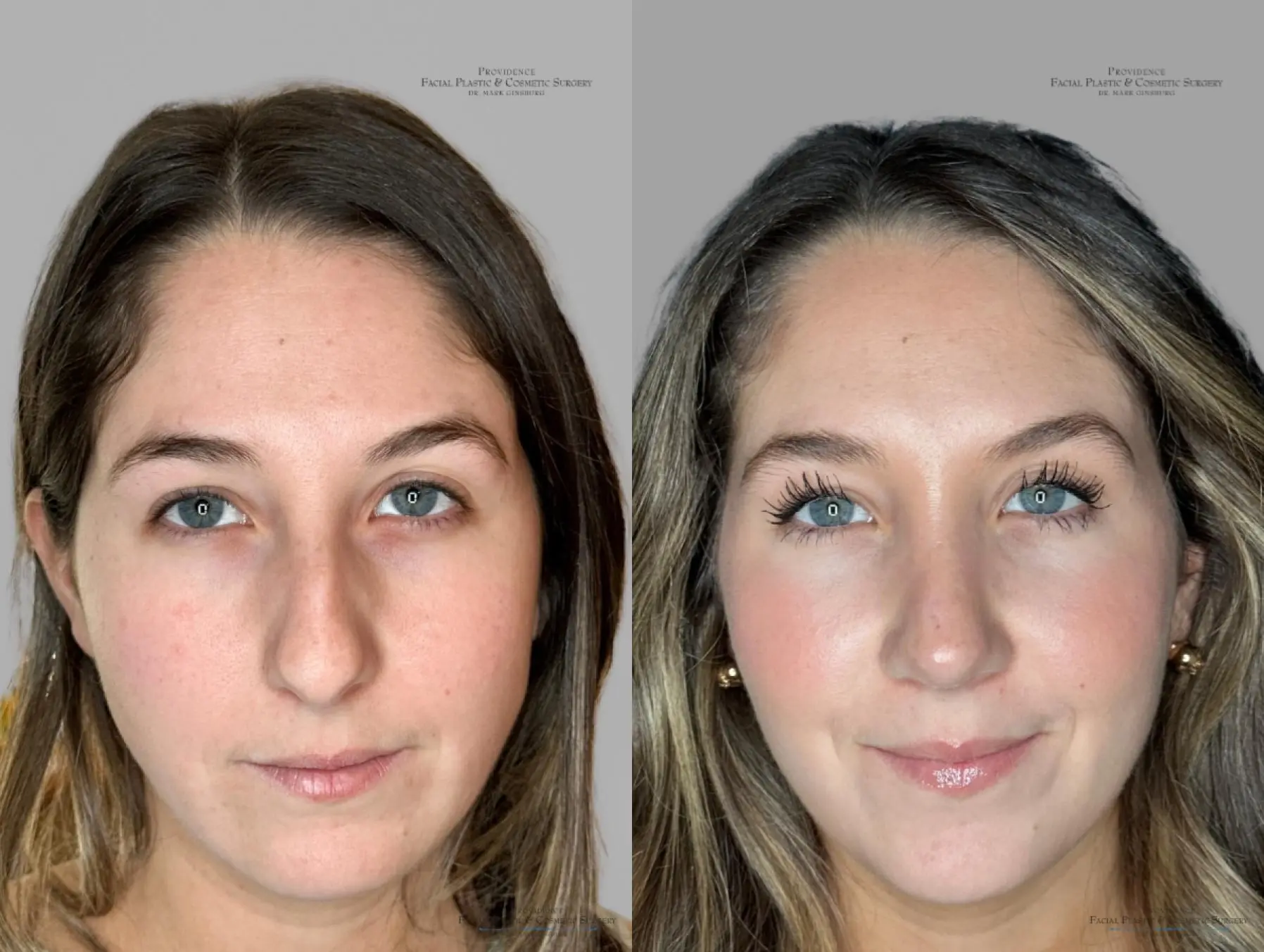 Rhinoplasty: Patient 36 - Before and After 1