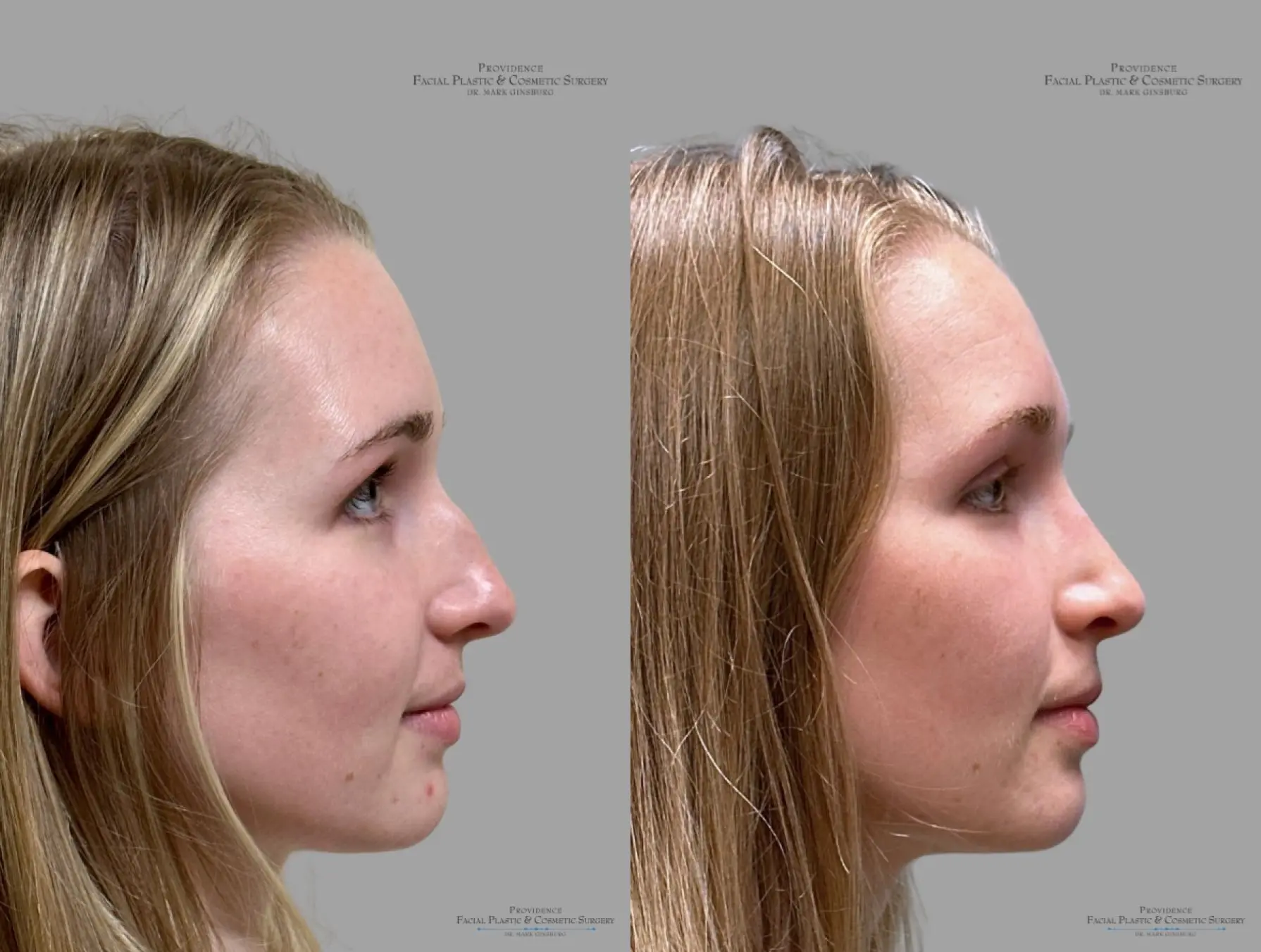 Rhinoplasty: Patient 39 - Before and After 3
