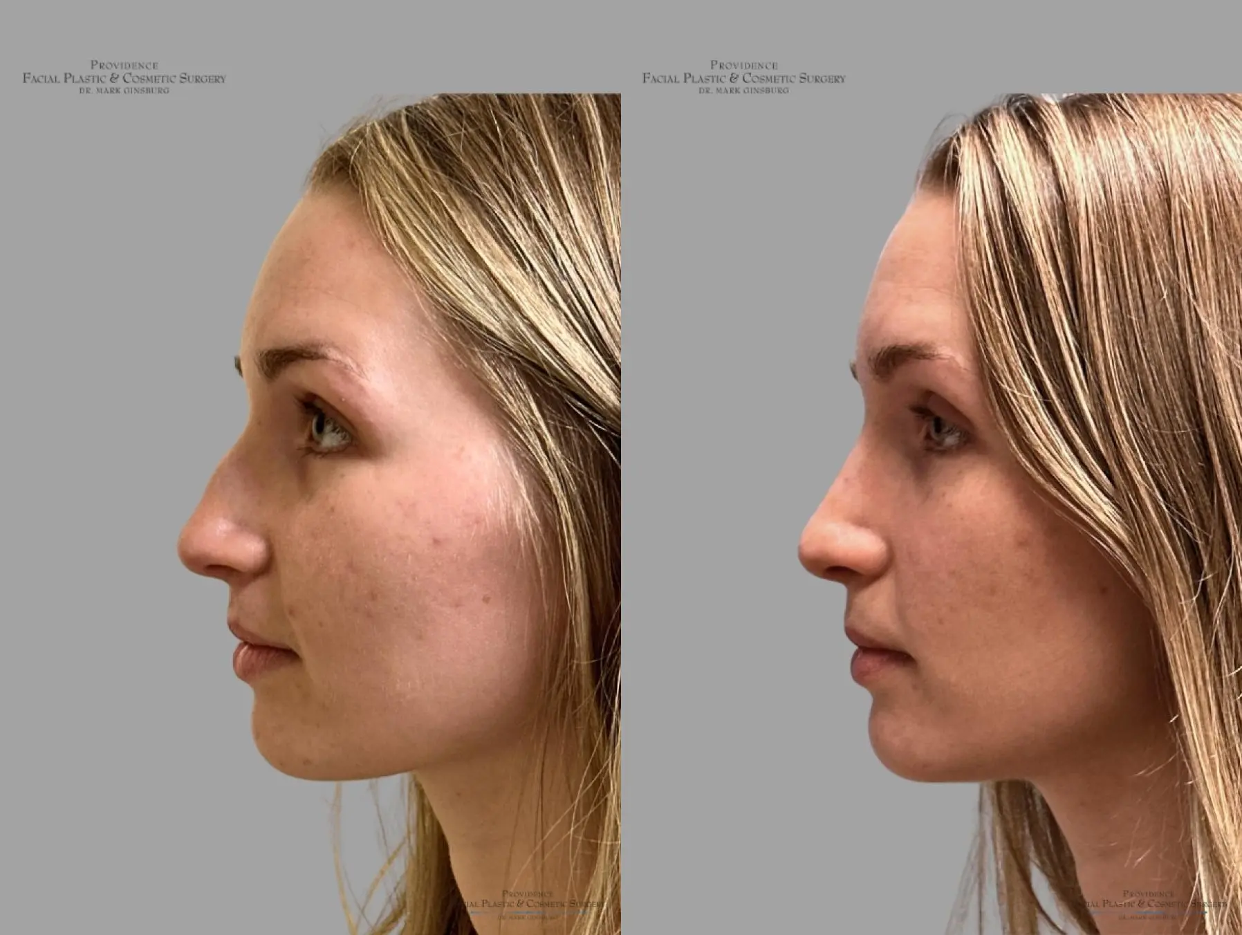 Rhinoplasty: Patient 39 - Before and After 6