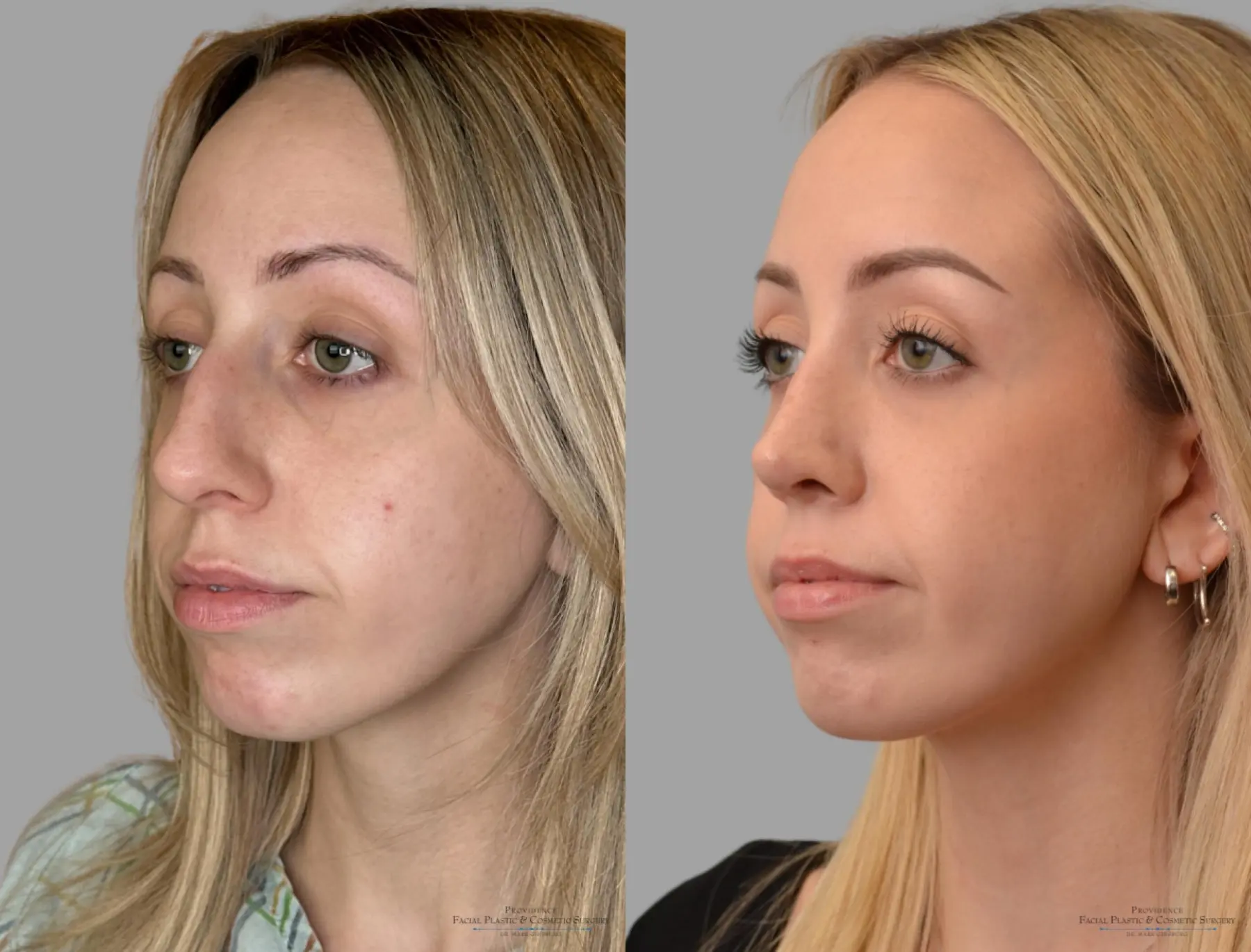 Rhinoplasty: Patient 42 - Before and After 4