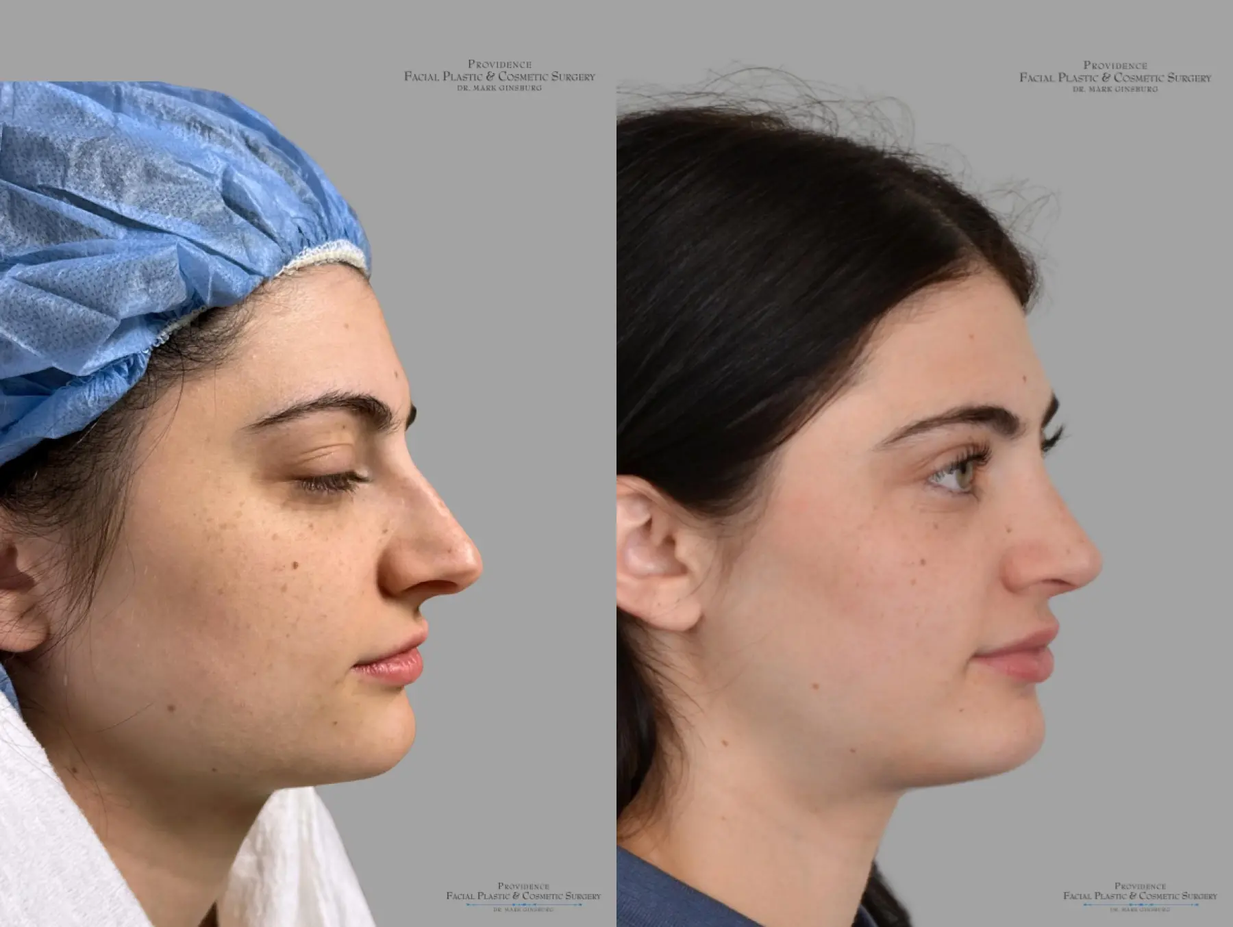 Rhinoplasty: Patient 43 - Before and After 3