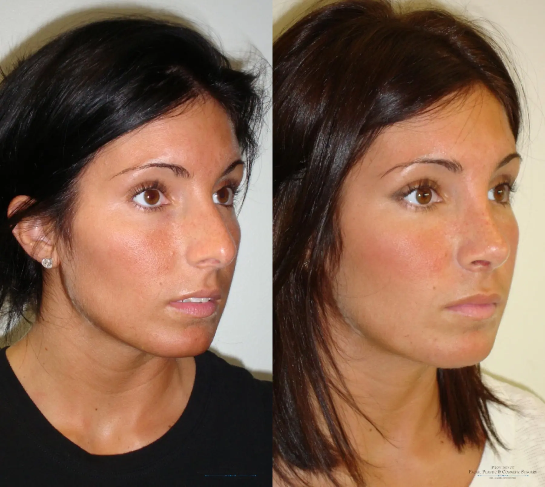 Rhinoplasty: Patient 11 - Before and After 2