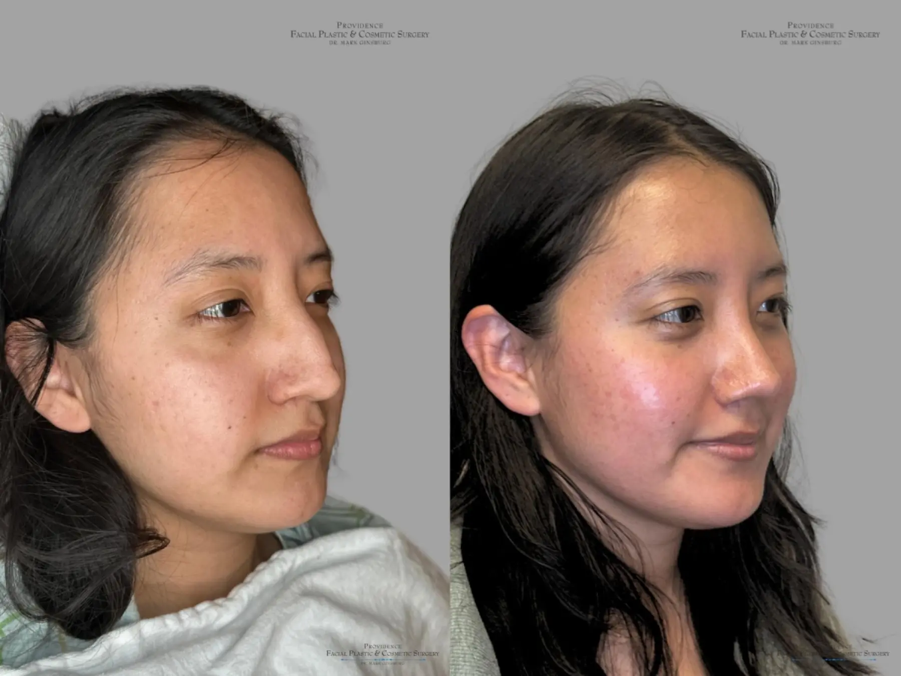 Rhinoplasty: Patient 31 - Before and After 2