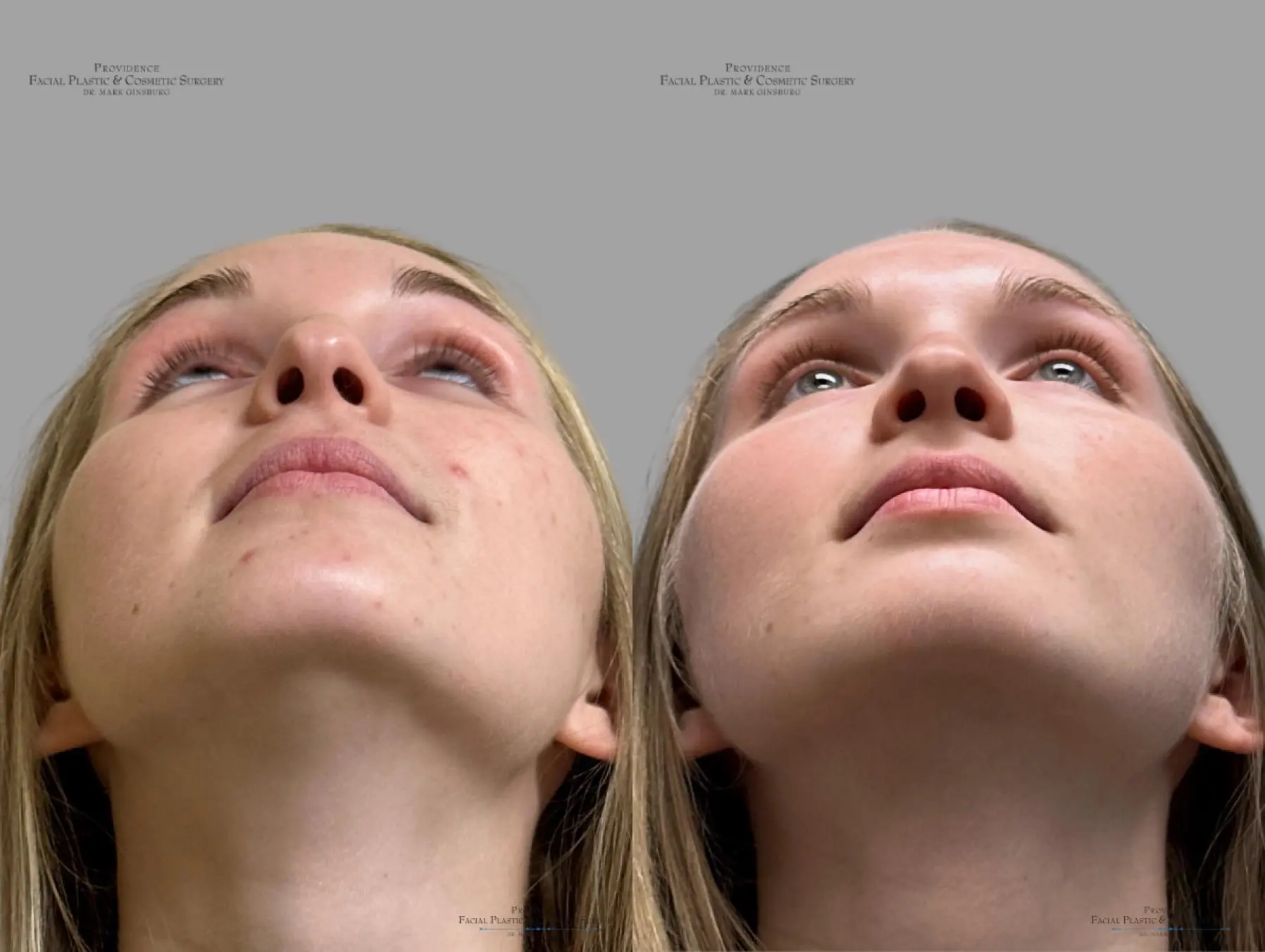 Rhinoplasty: Patient 39 - Before and After 4