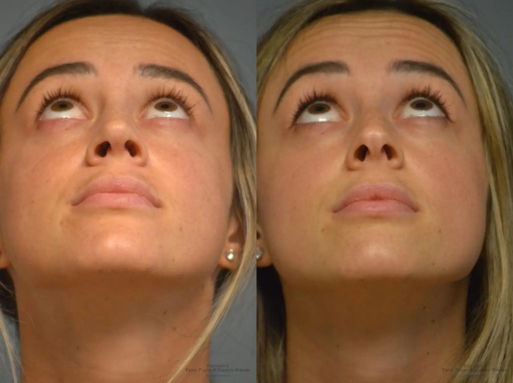Rhinoplasty: Patient 9 - Before and After 4