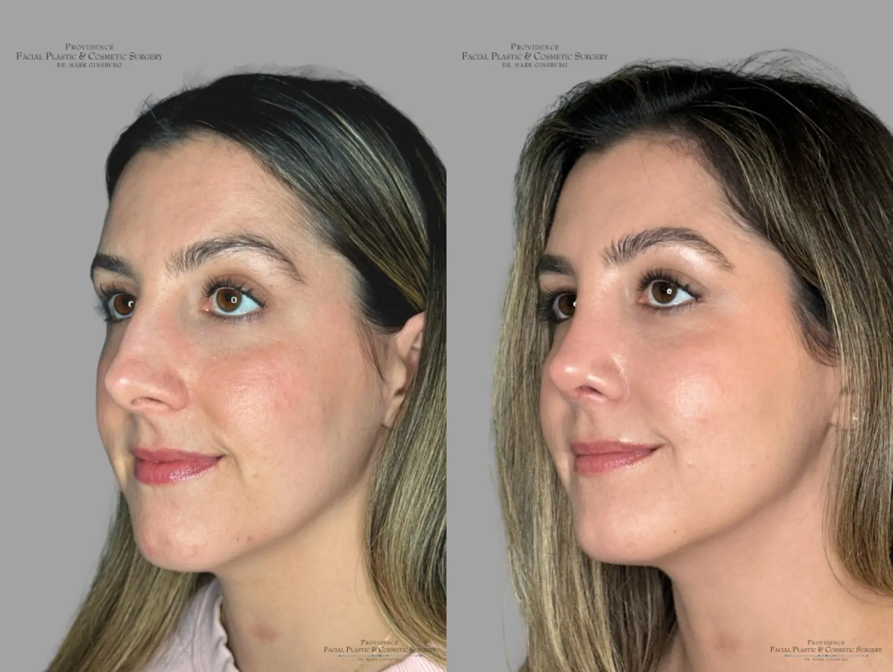Rhinoplasty: Patient 40 - Before and After 4