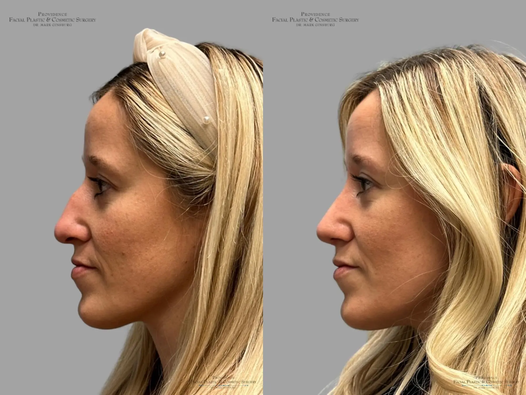 Rhinoplasty: Patient 34 - Before and After 6