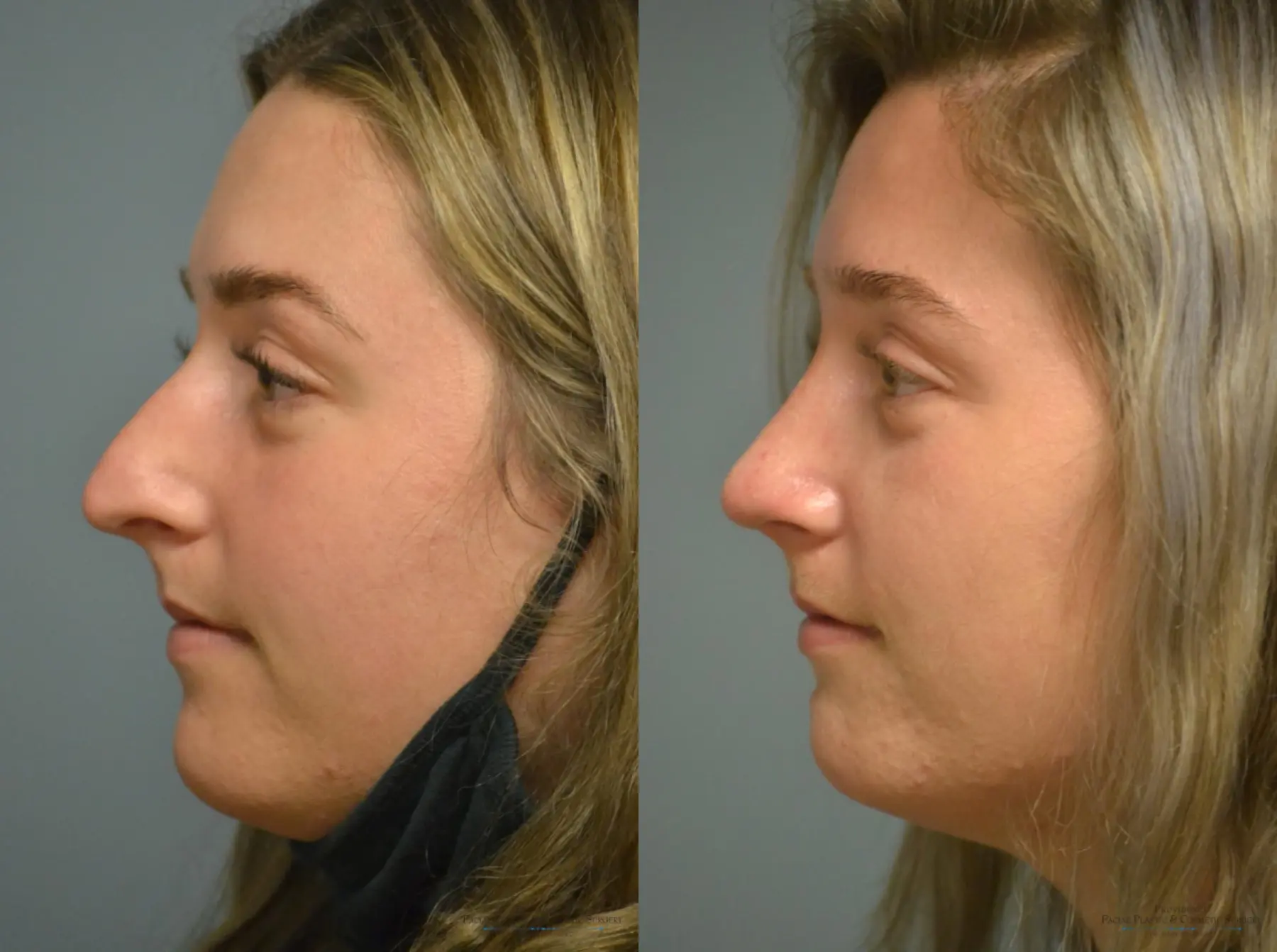 Rhinoplasty: Patient 7 - Before and After 3