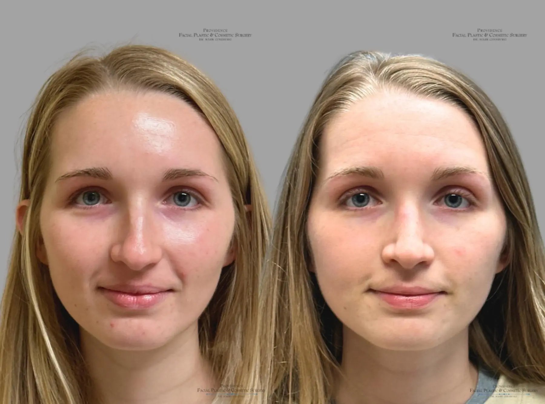 Rhinoplasty: Patient 39 - Before and After 1