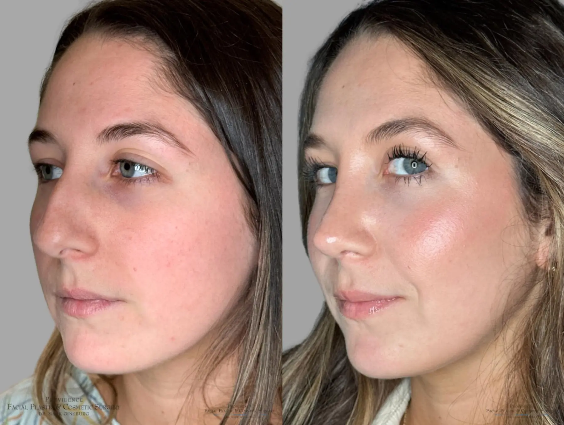 Rhinoplasty: Patient 36 - Before and After 4