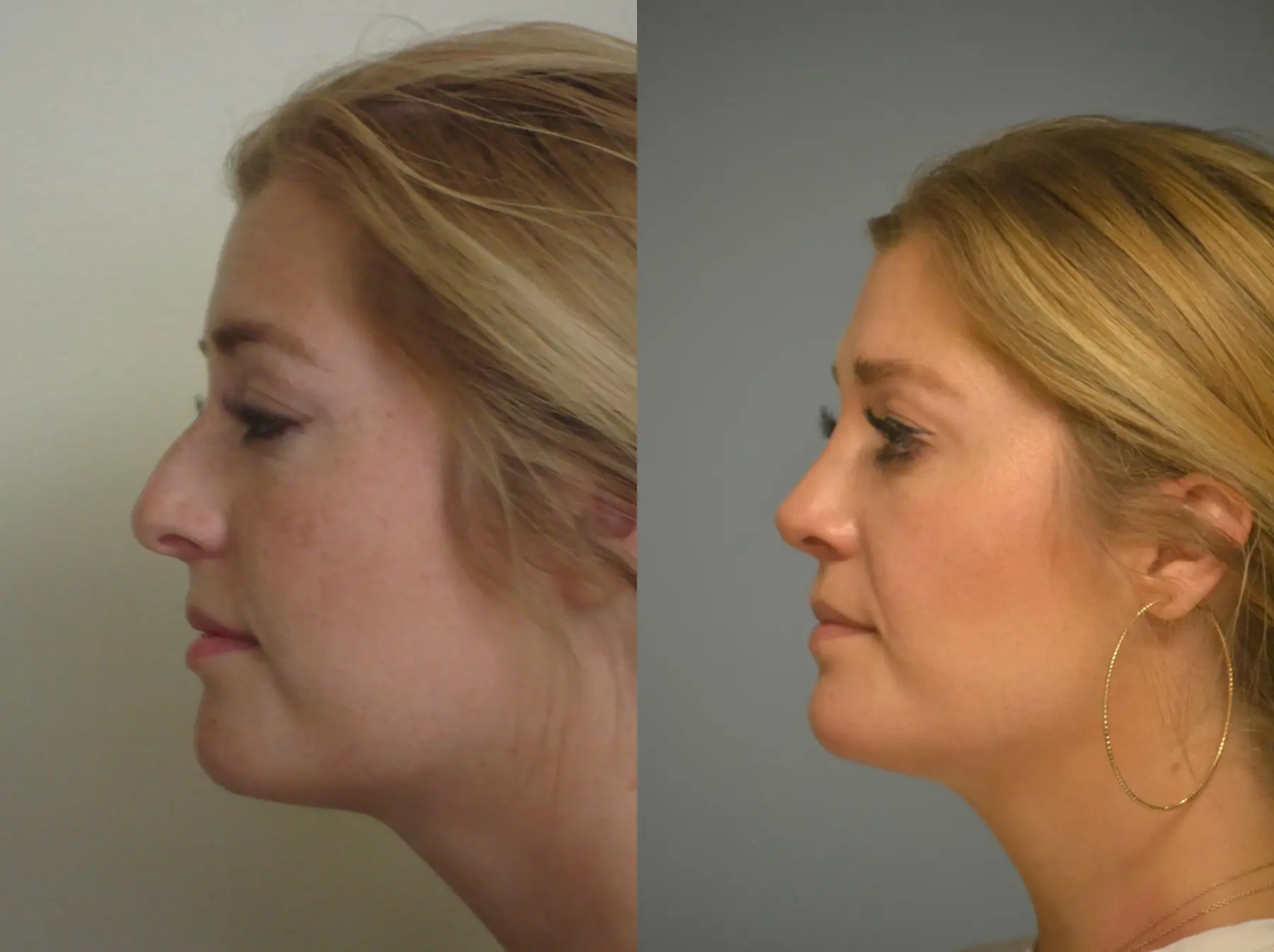 Rhinoplasty: Patient 25 - Before and After 2