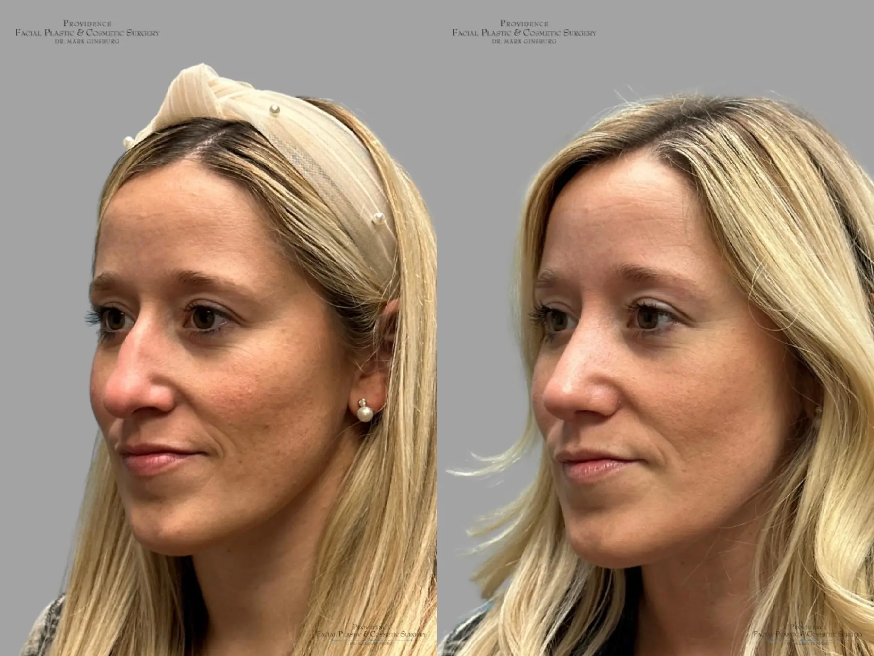 Rhinoplasty: Patient 34 - Before and After 5