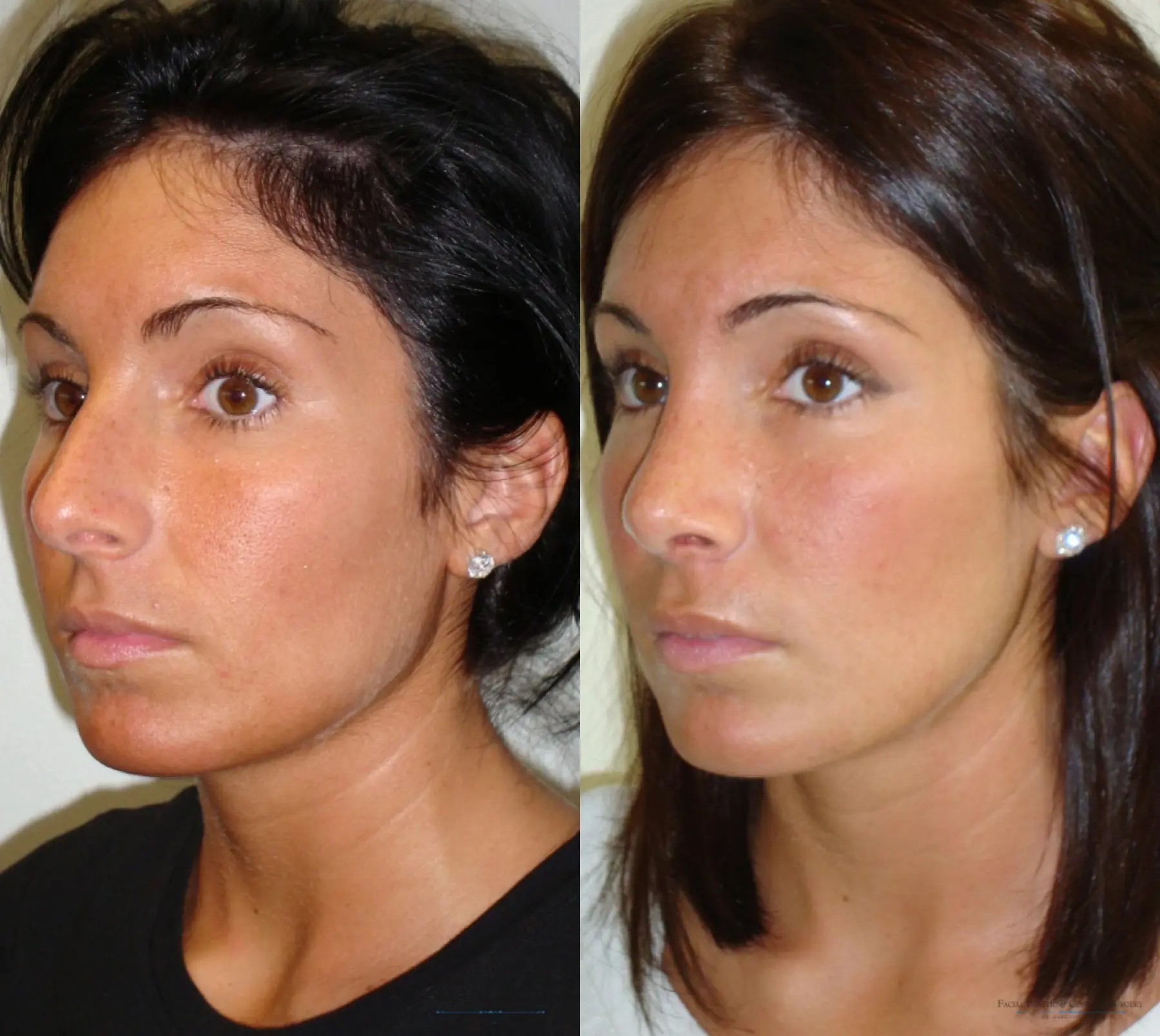 Rhinoplasty: Patient 11 - Before and After 4