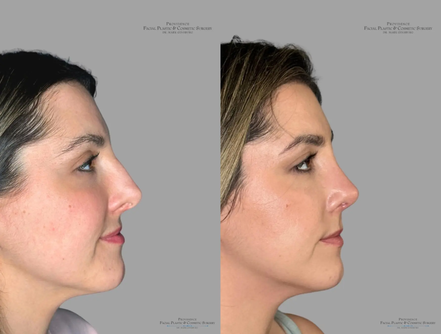 Rhinoplasty: Patient 40 - Before and After 3