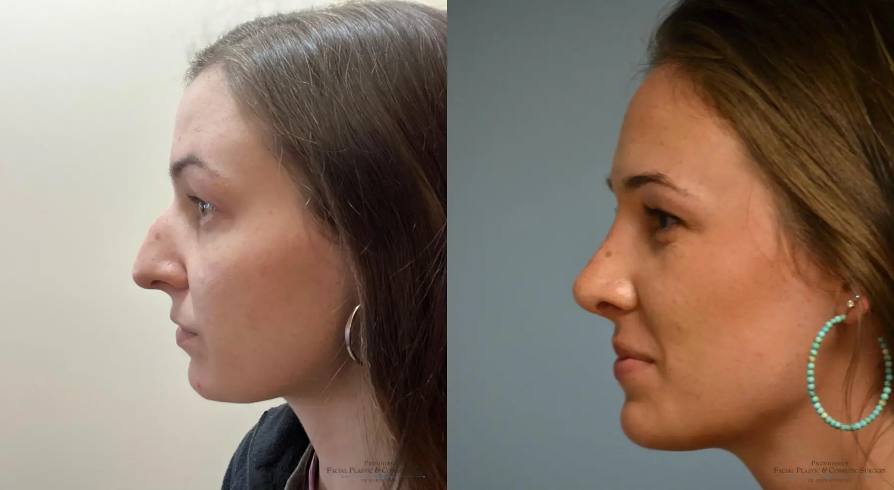 Rhinoplasty: Patient 42 - Before and After 2