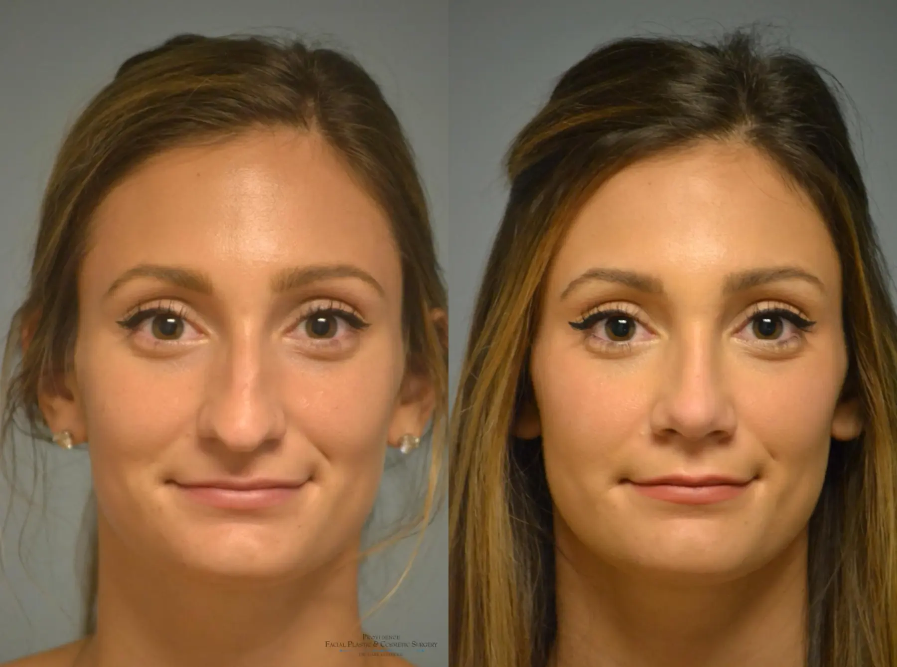 Rhinoplasty: Patient 1 - Before and After 1